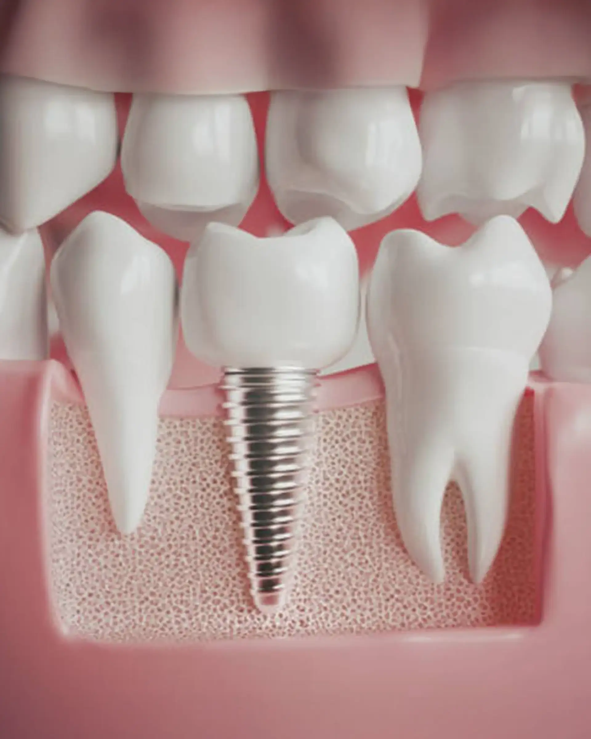 Leczenie implantami w Istanbul Care