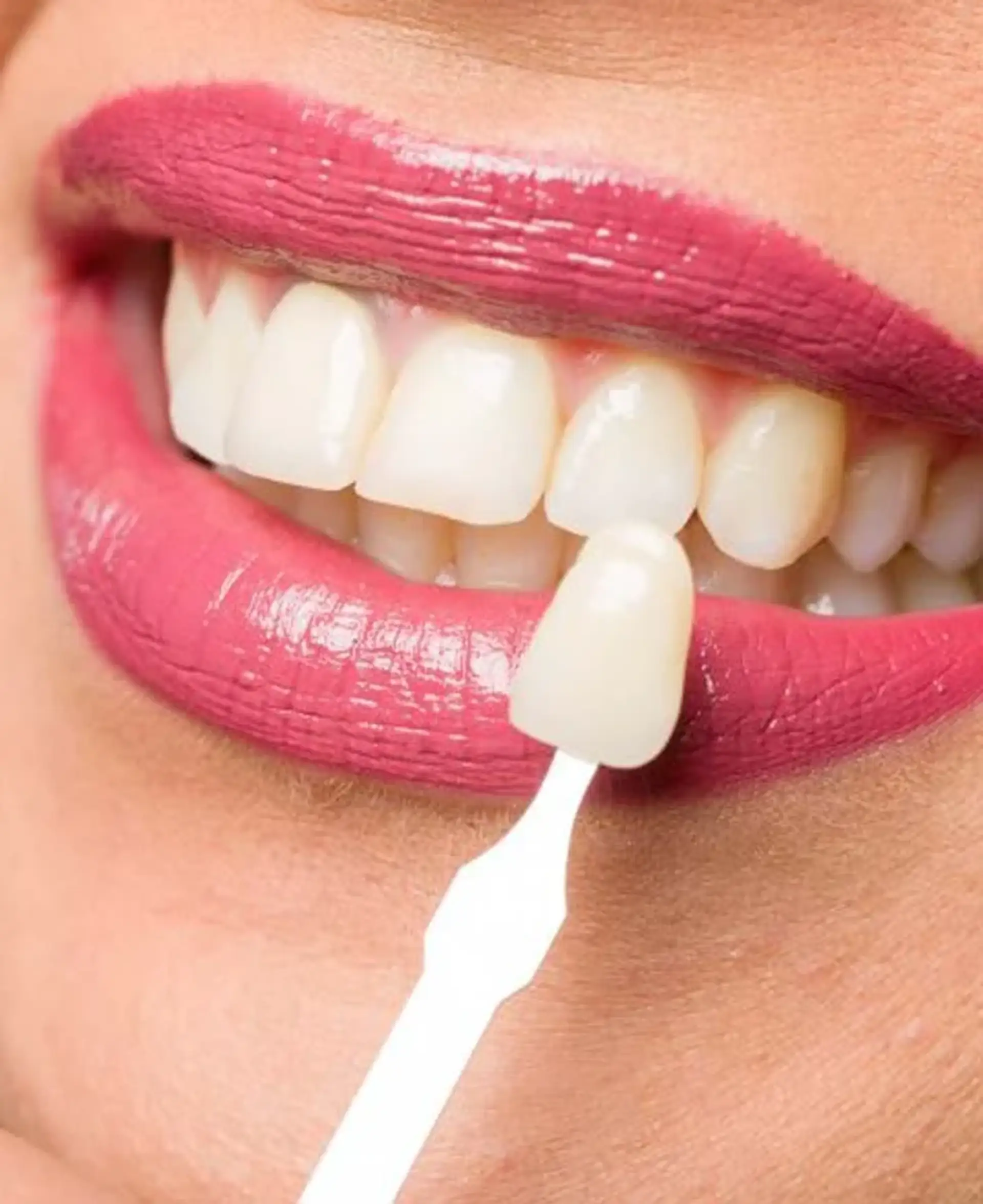 Trasforma il tuo sorriso con le faccette E-max