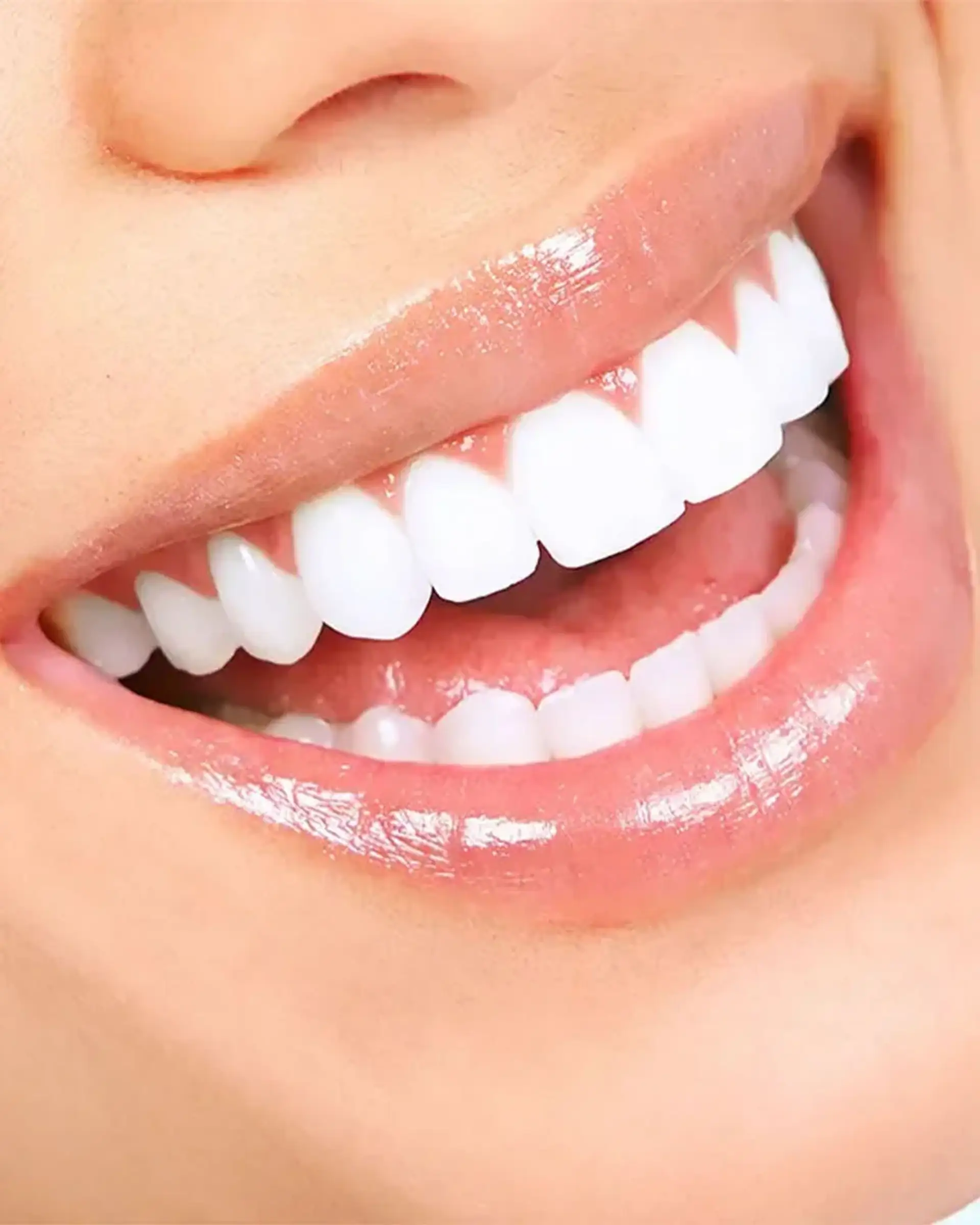 Primo piano di un sorriso splendente con denti bianchi perfetti.