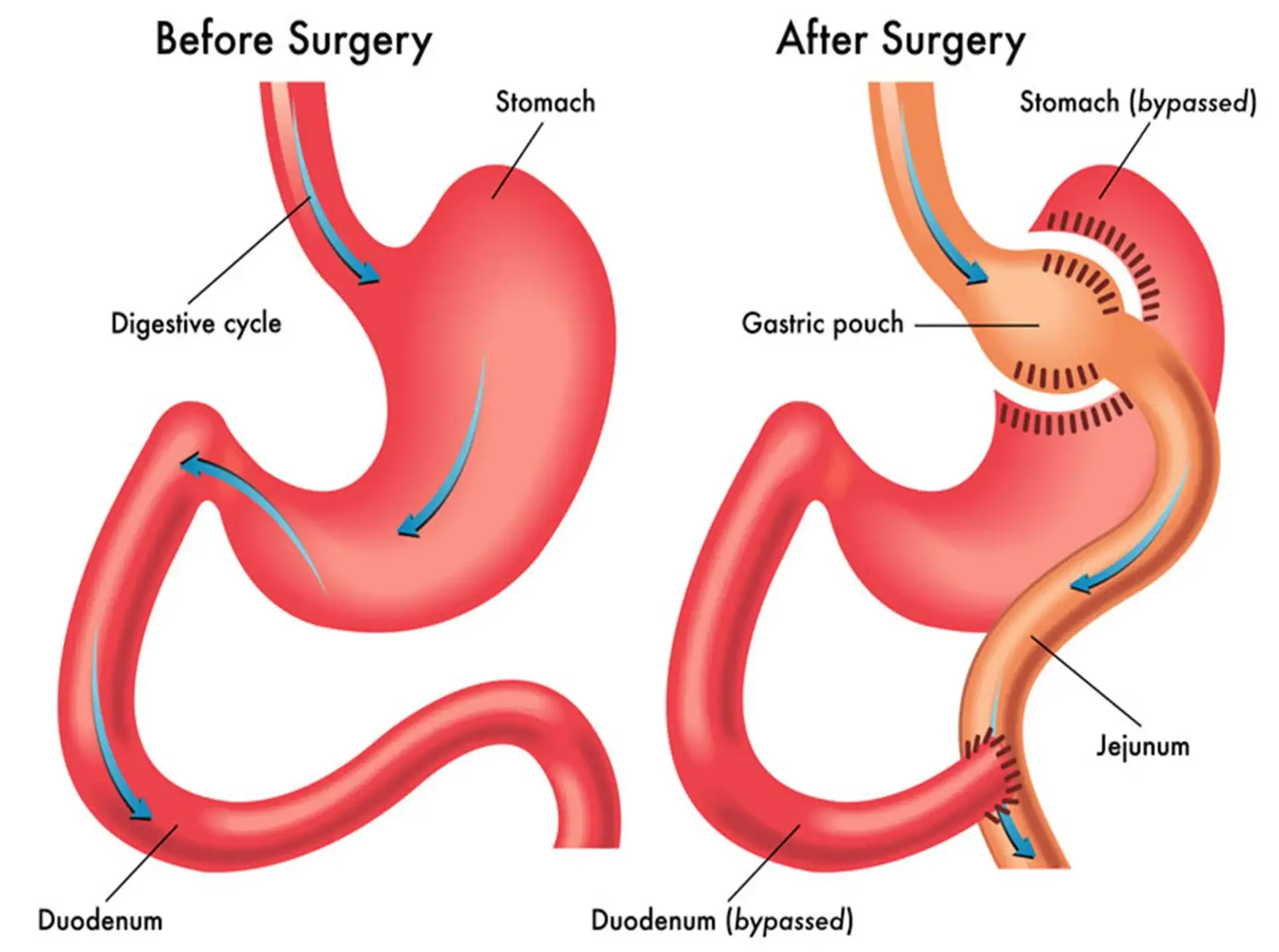 Diagrami që tregon stomakun para dhe pas një operacioni për bypass gastrik.