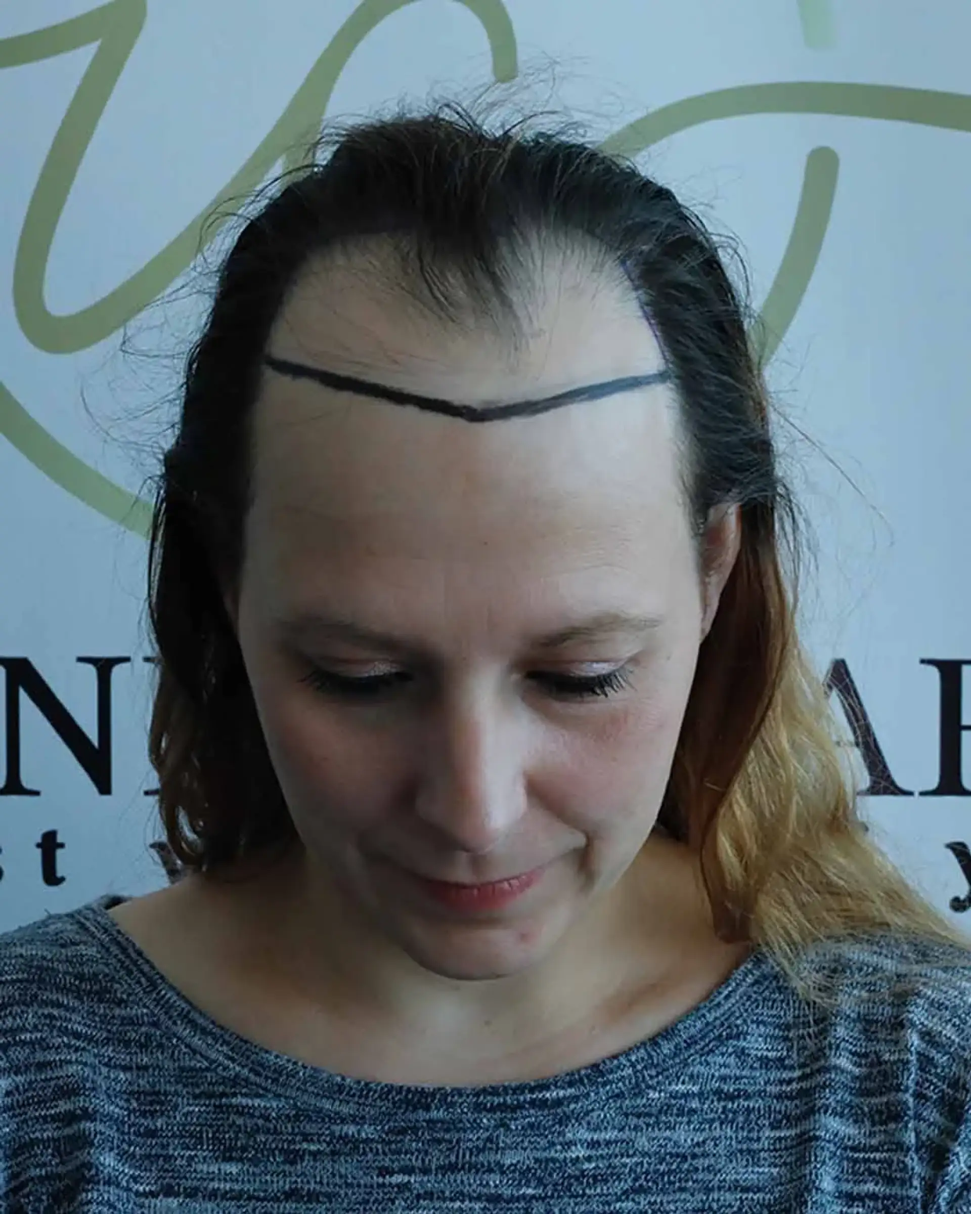 What is a Female Hair Transplant Service