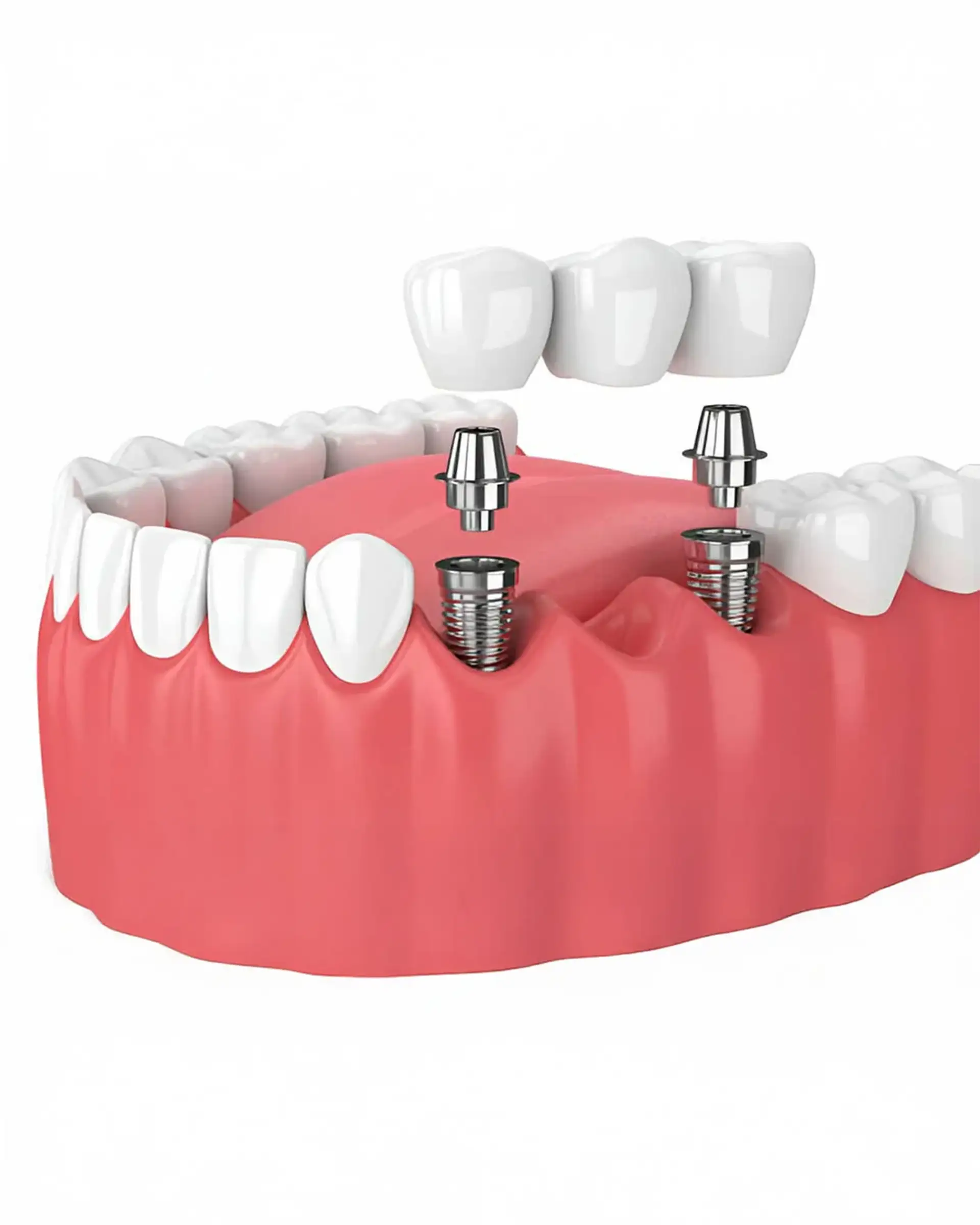 Dlaczego warto wybrać implant dentystyczny zamiast tradycyjnej protezy lub mostu?