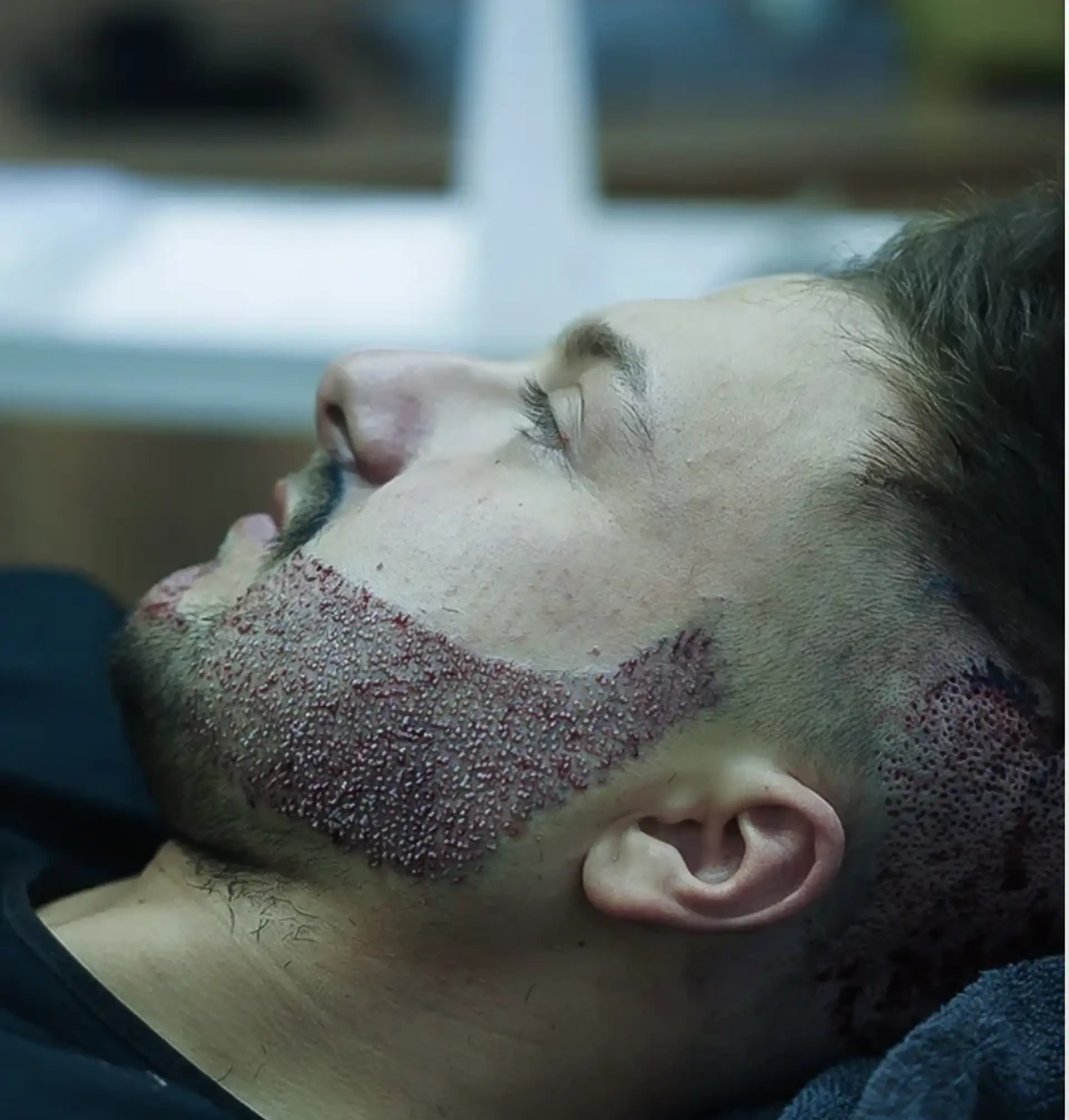 beard transplant