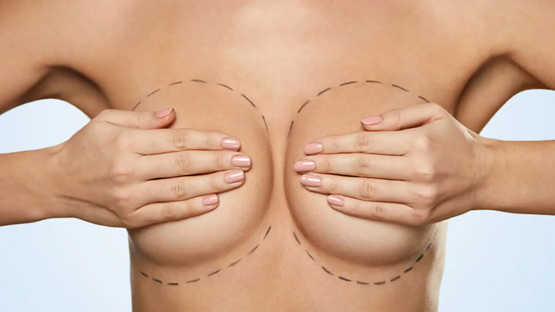 Preparing for Breast Reduction