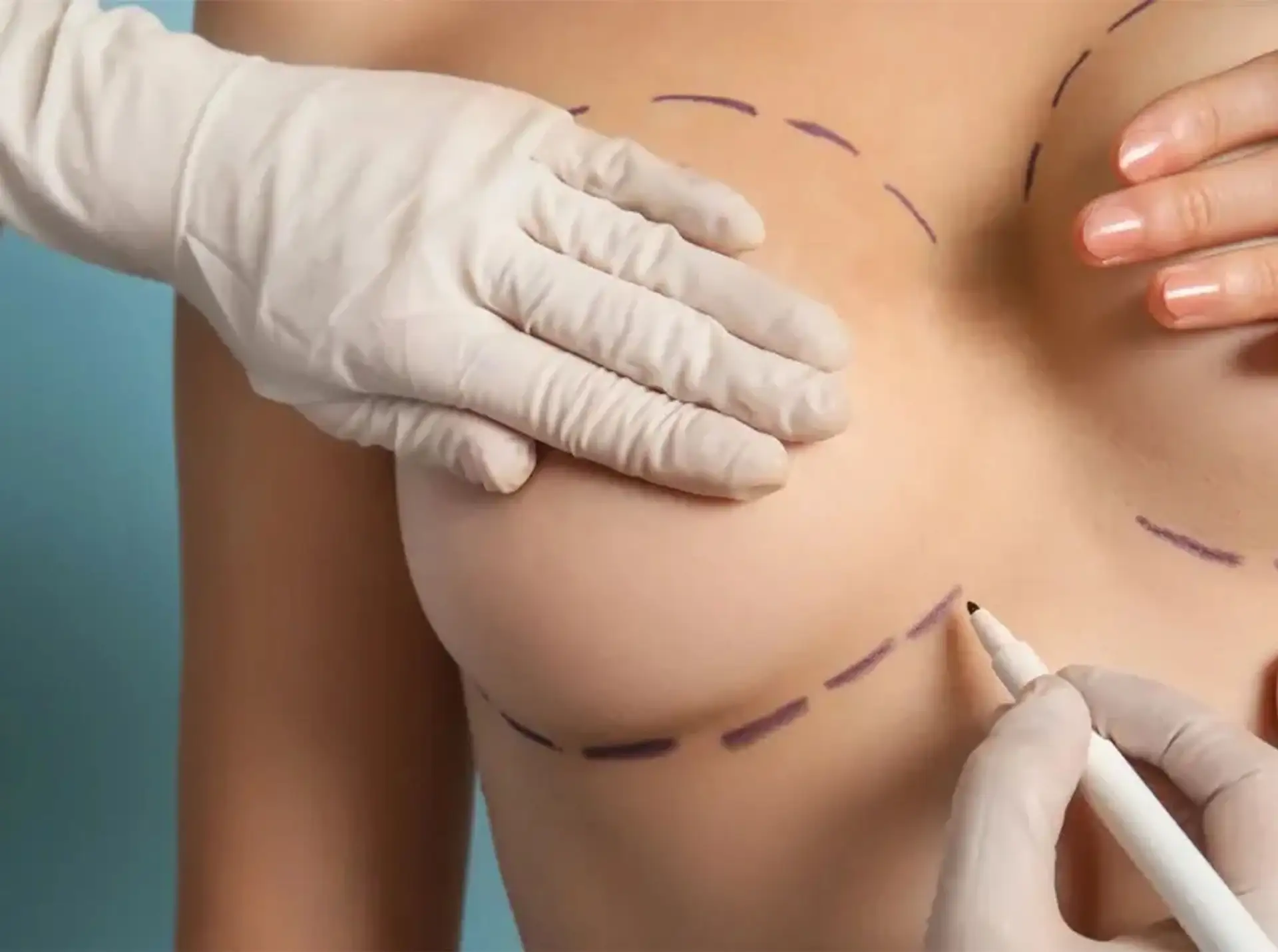 What Is Breast Reduction?