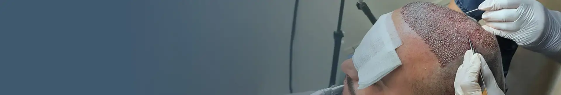 Transplant de păr FUE