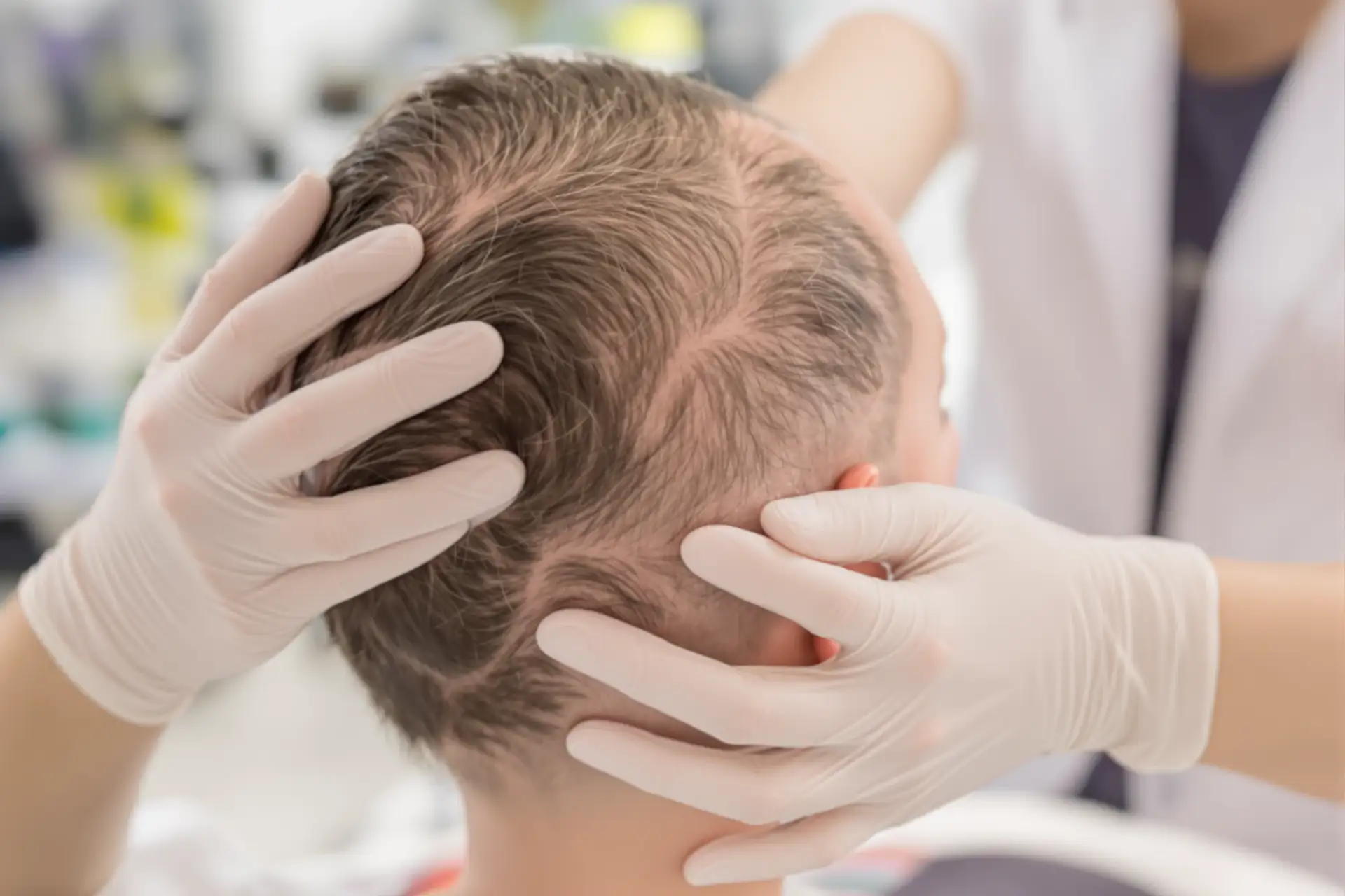 Come curare il cuoio capelluto dopo un trapianto