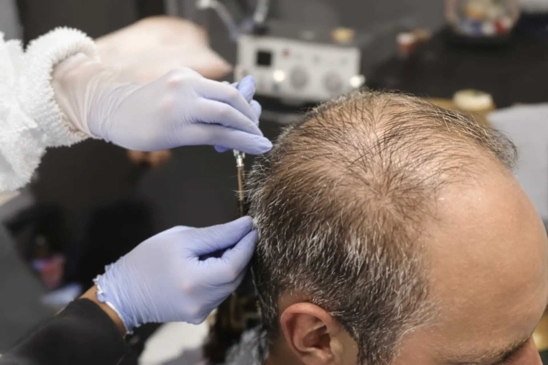 Spot Crown Balding Early: Signs and Treatments