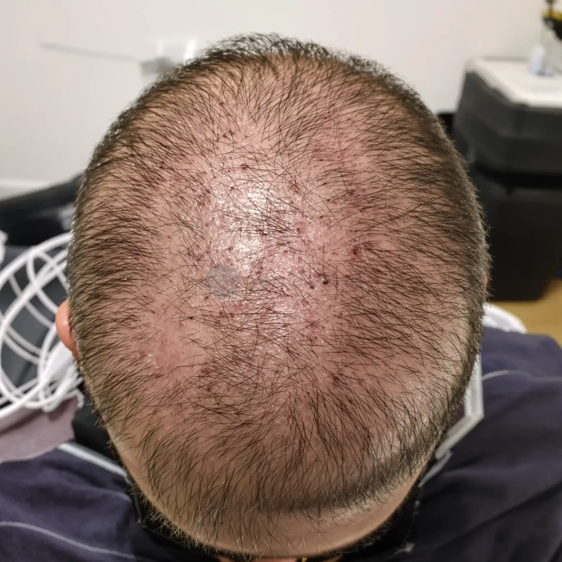 Un trapianto di capelli fa male – procedura.