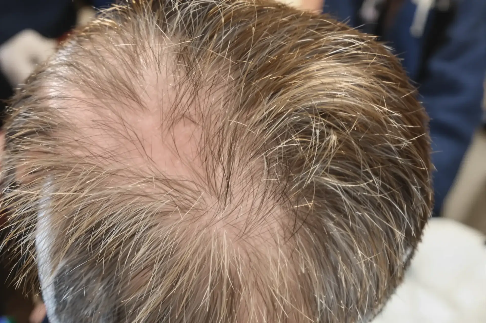 FUE Hair Transplant in Turkey: Cost, Procedure & Results
