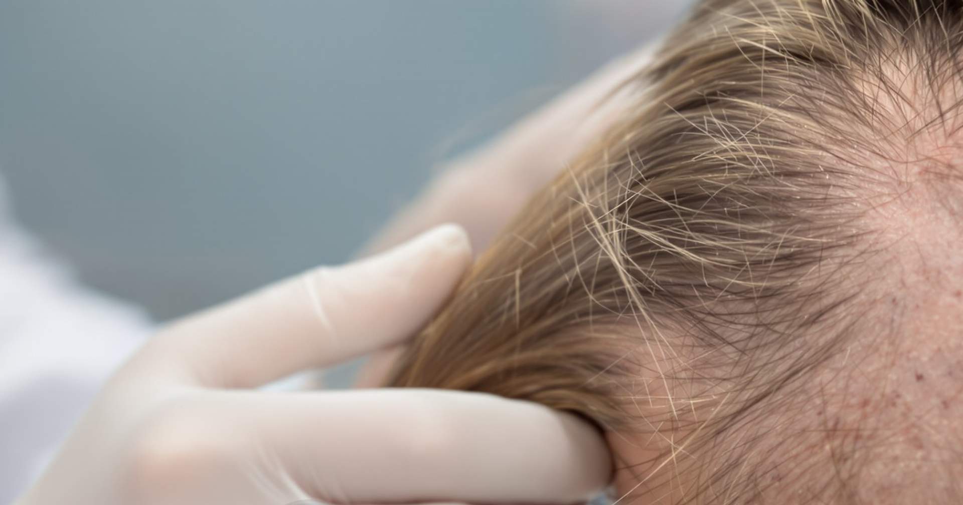 Mezoterapia włosów: Jak działa mezoterapia włosów krok po kroku — Istanbul Care