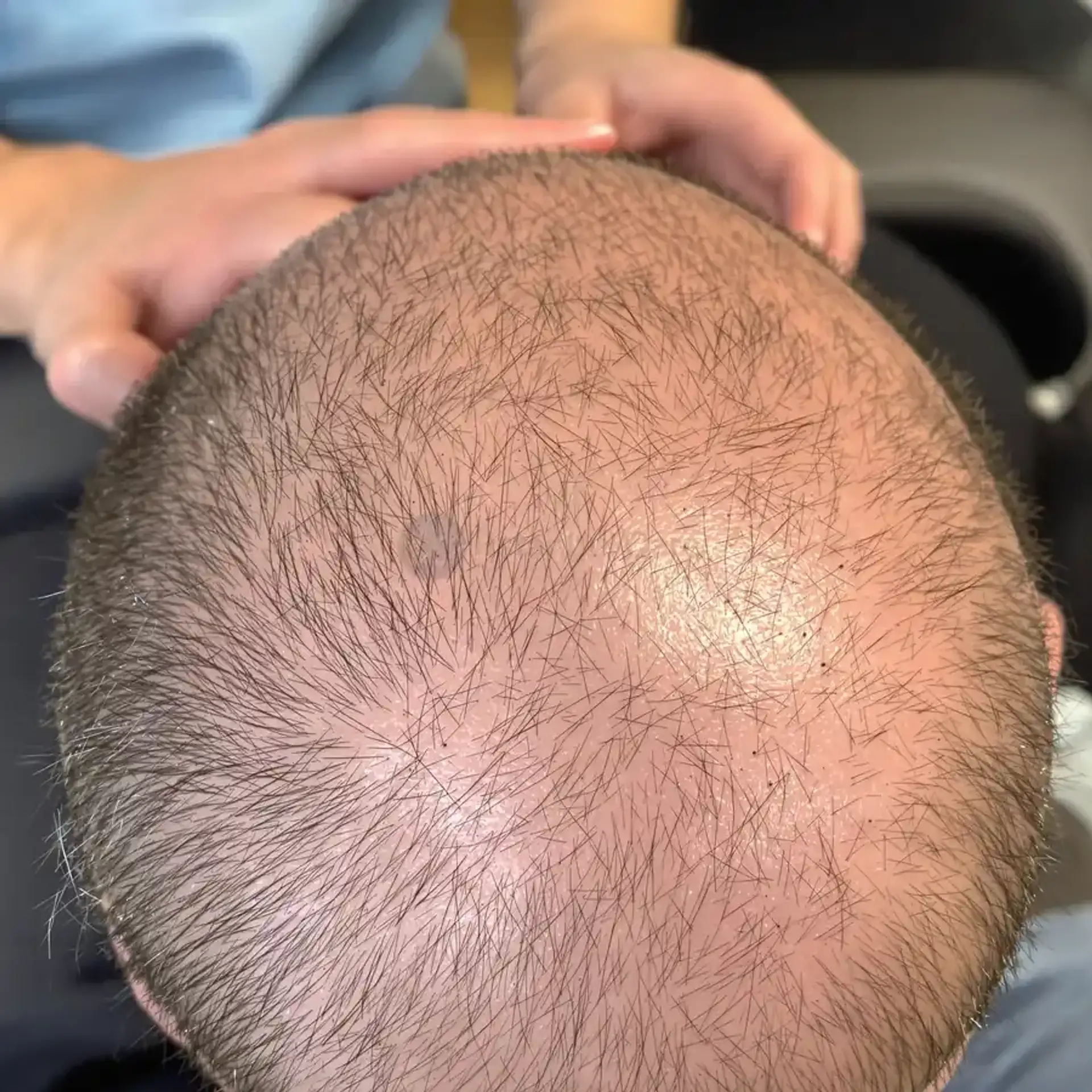 Trapianto di capelli Turchia o USA – procedura.