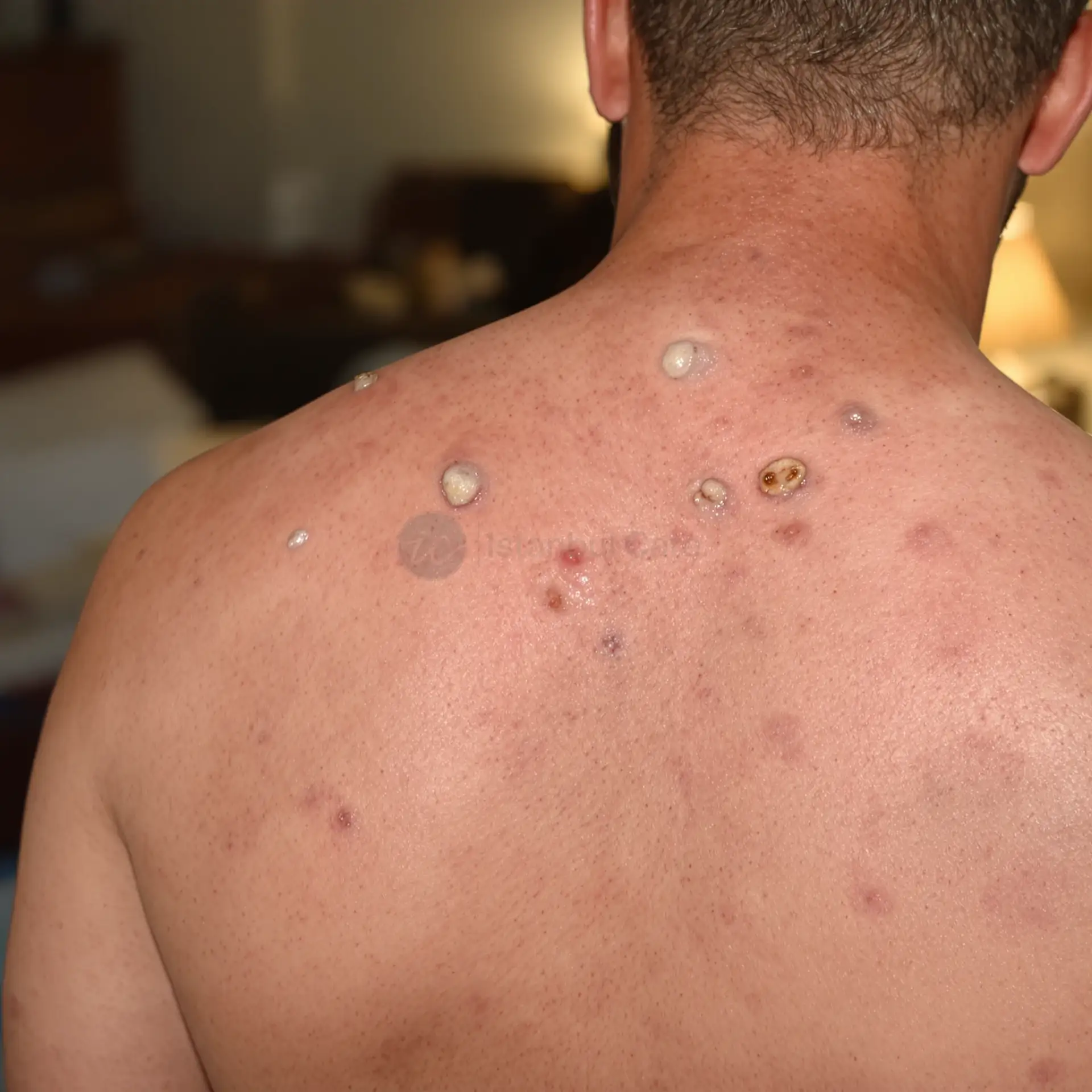 Schiena con follicoli piliferi gravemente infetti, con pustole e lesioni crostose.