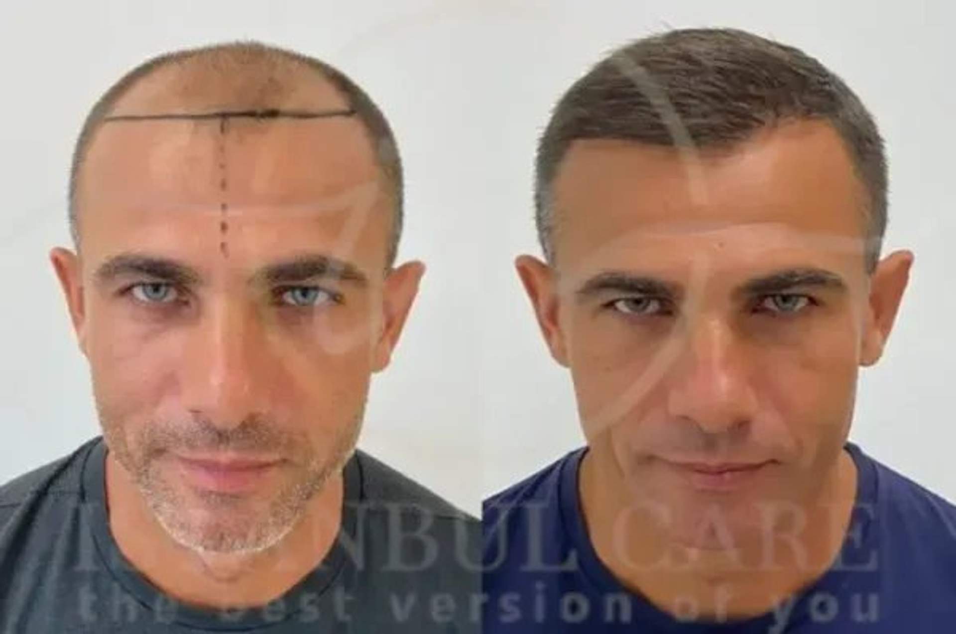 Entrada de cabello: qué es, qué lo causa y cómo detenerlo o solucionarlo