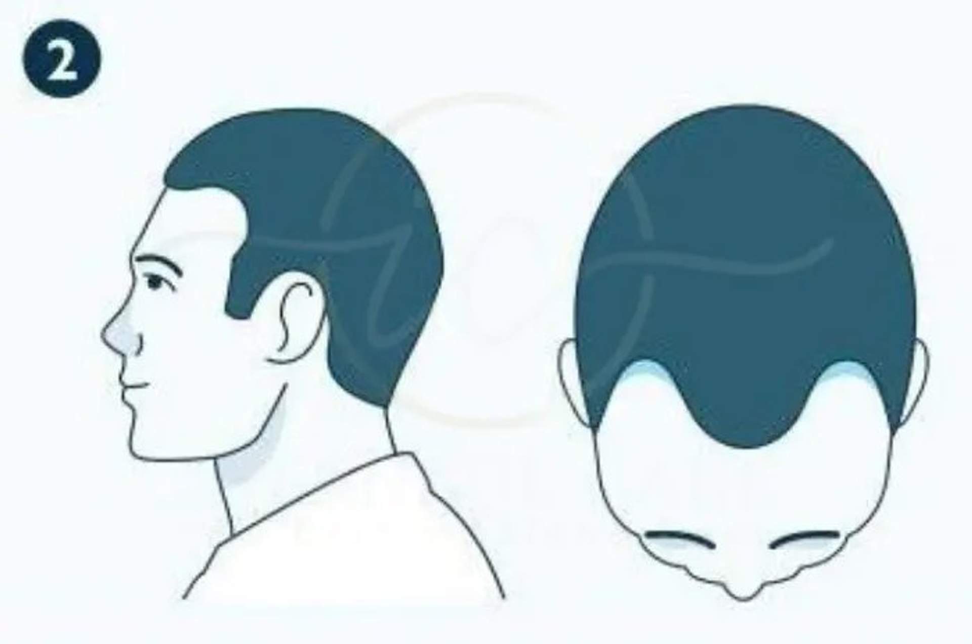 Greffe de cheveux Norwood 2 Avant et Après