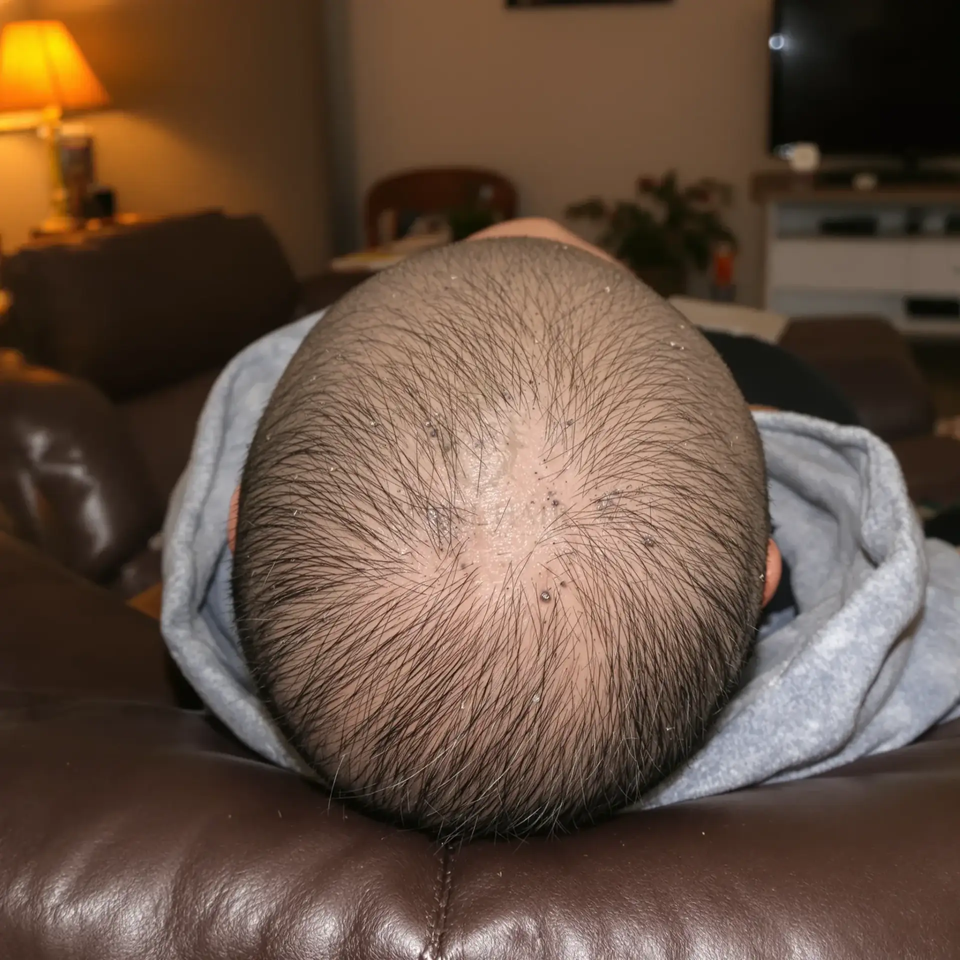Vista dall'alto di un cuoio capelluto nei primi giorni dopo un trapianto di capelli, con piccole croste attorno a ogni innesto