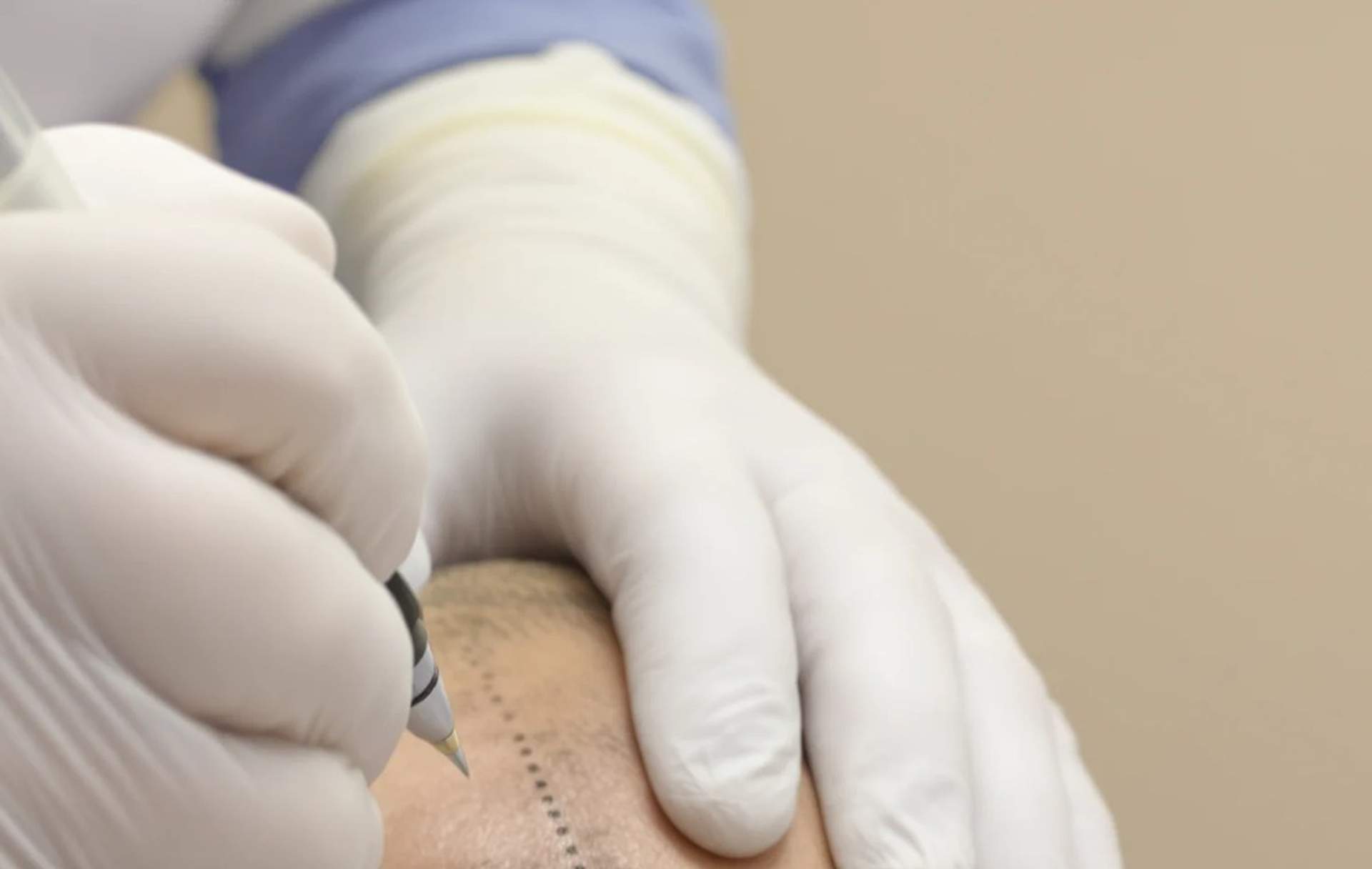 Trattamento PRP per Capelli: Come Funziona e Cosa Aspettarsi — Istanbul Care