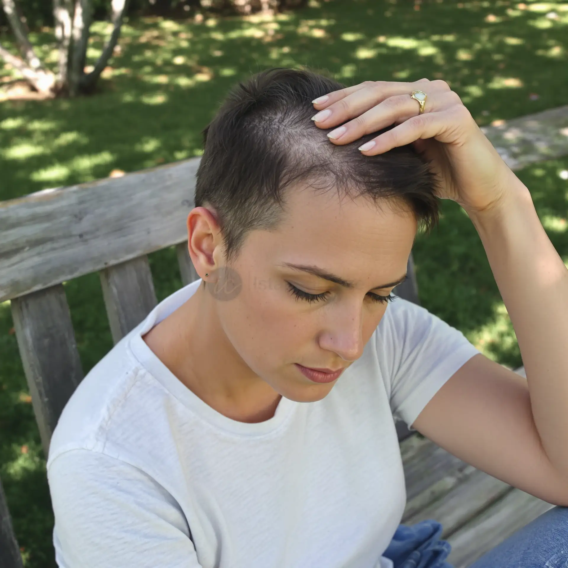 Cronologia dei risultati del trapianto di capelli – procedura.