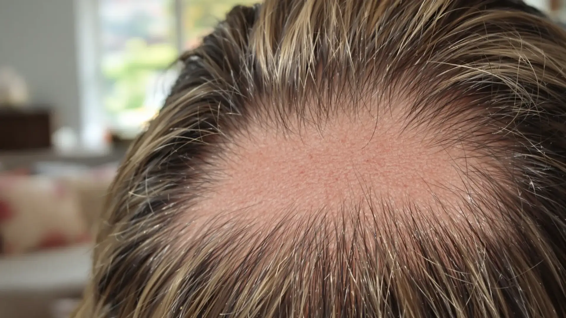Generic stock illustration: an anonymous head seen from above with scalp visible through the hair at the crown. Not a photograph of any named person.