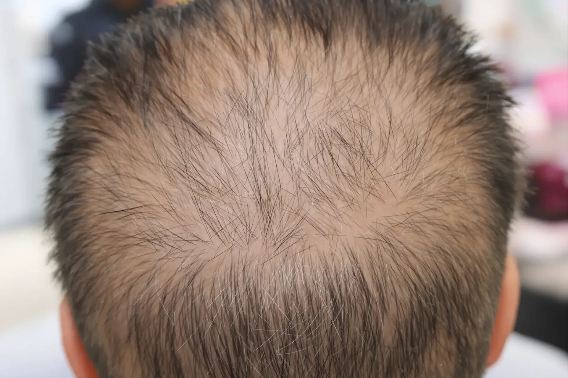 Trapianti di capelli in Turchia vs locali: costo e qualità