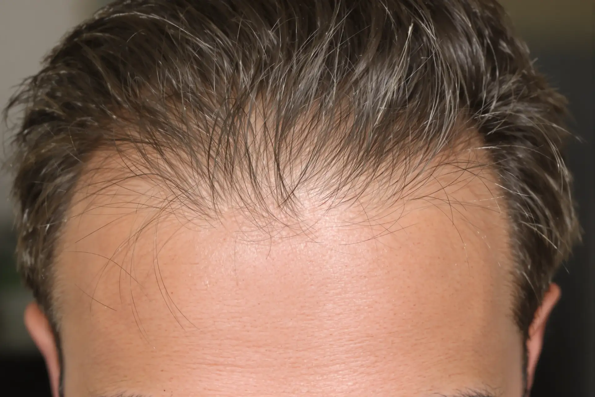 Cronologia dei risultati del trapianto di capelli: mese per mese