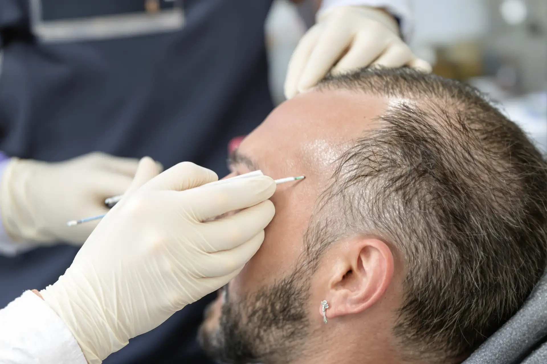 Come Funziona un Trapianto di Capelli: Passo dopo Passo — Spiegato