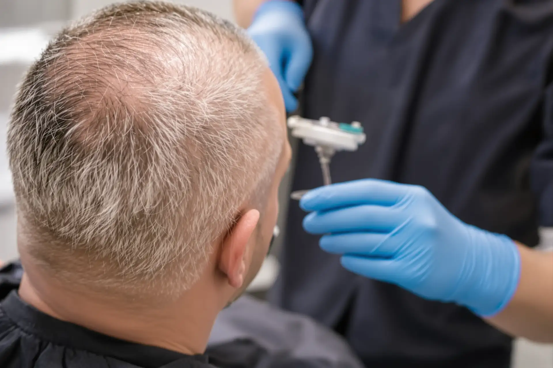 Types et méthodes de greffe de cheveux comparés