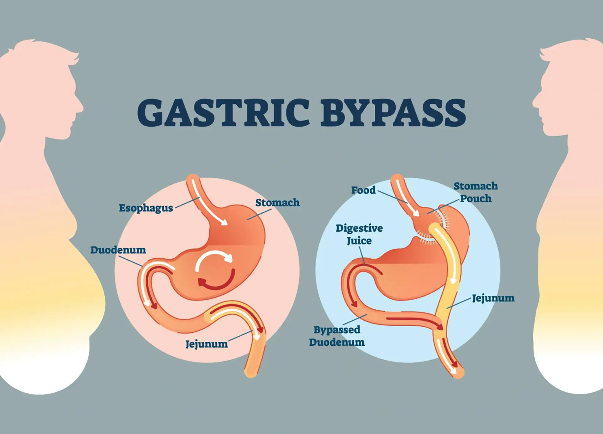 obesidade-alternativas-à-cirurgia de bypass gástrico
