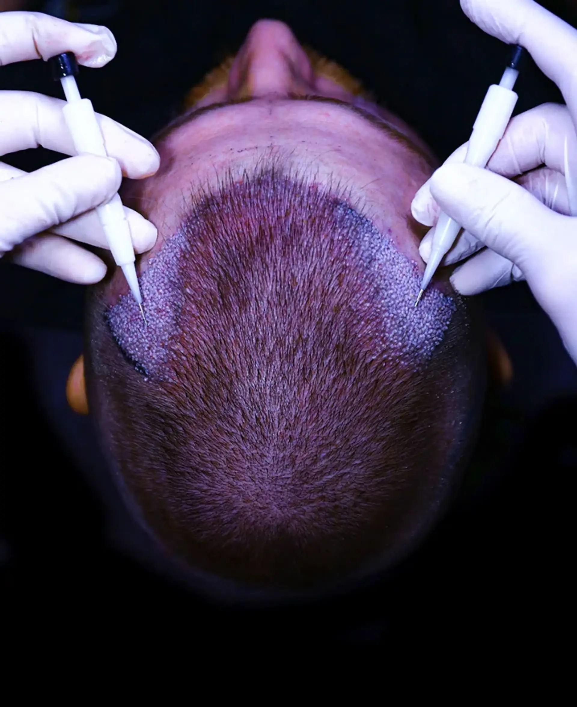 benefici del trapianto di capelli