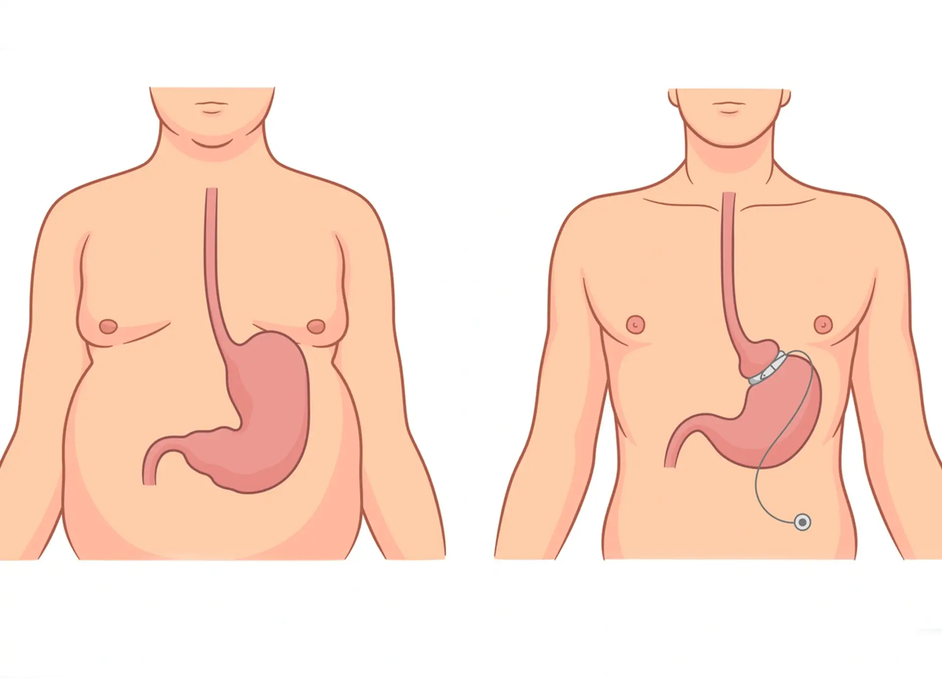 obezitate-gastric-banda-chirurgie