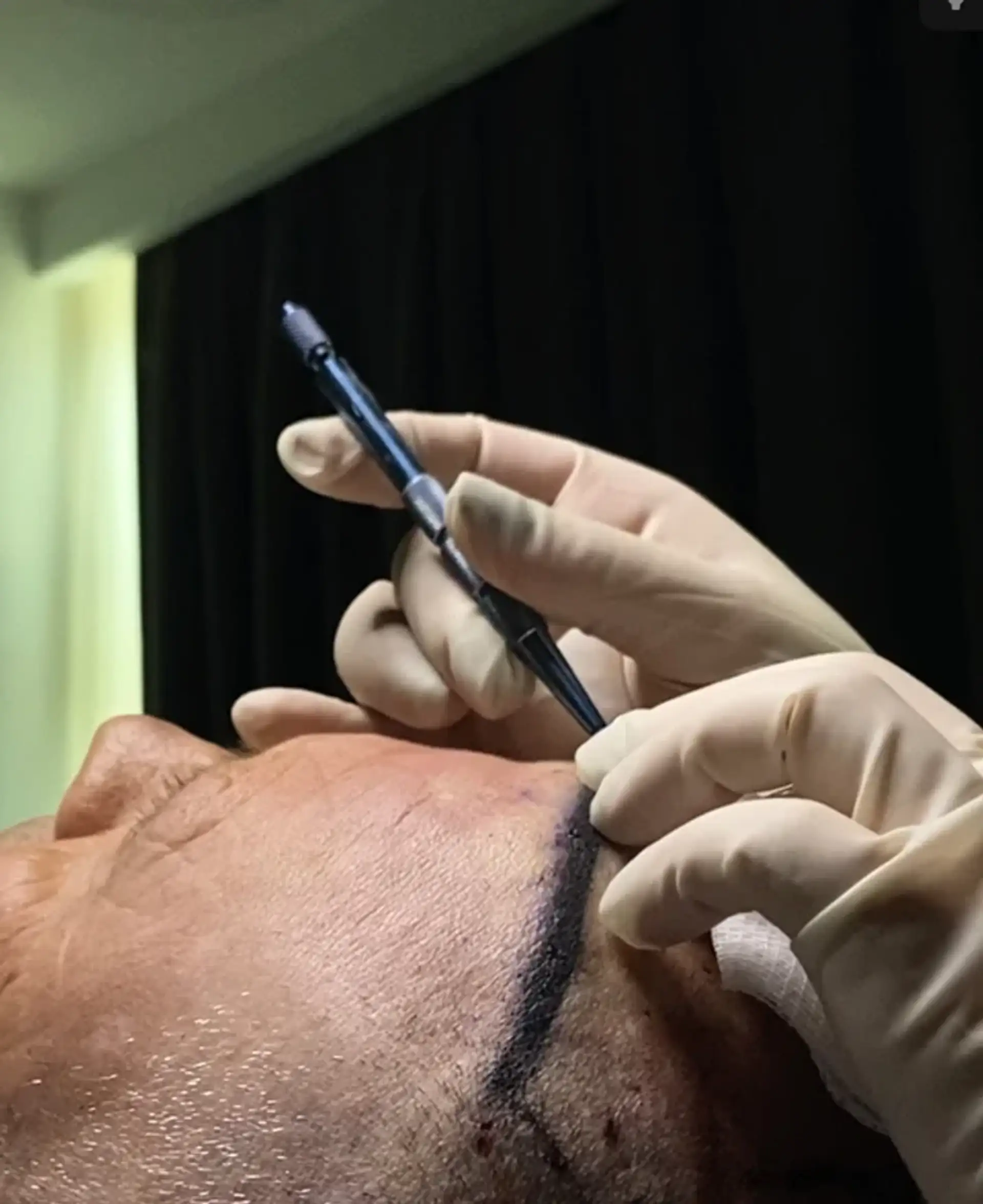 perché-scegliere-tirana-per-il-trapianto-di-capelli