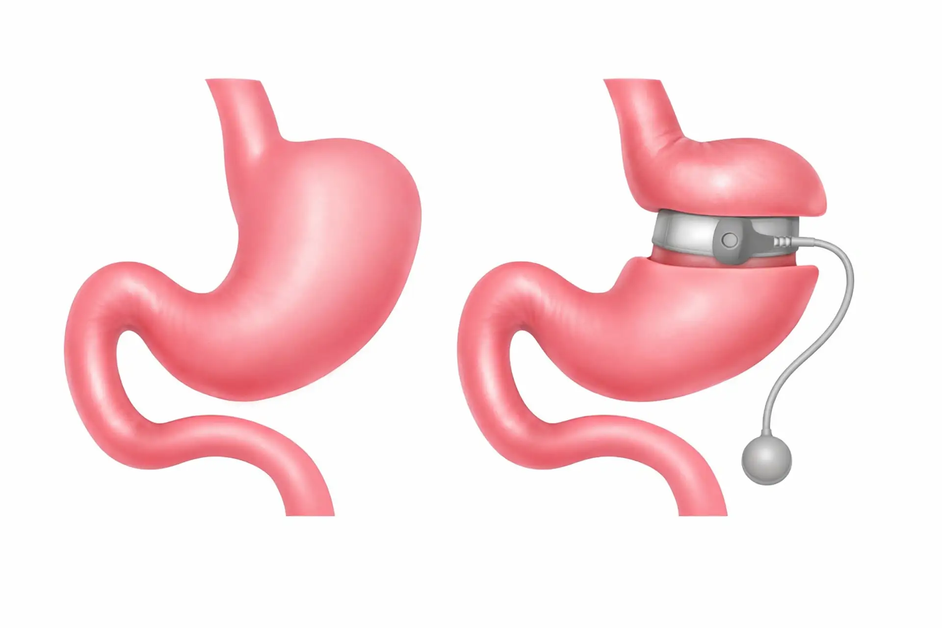 obesidade-qual-é-o-custo-da-cirurgia-de-revascularização-gástrica-na-turquia