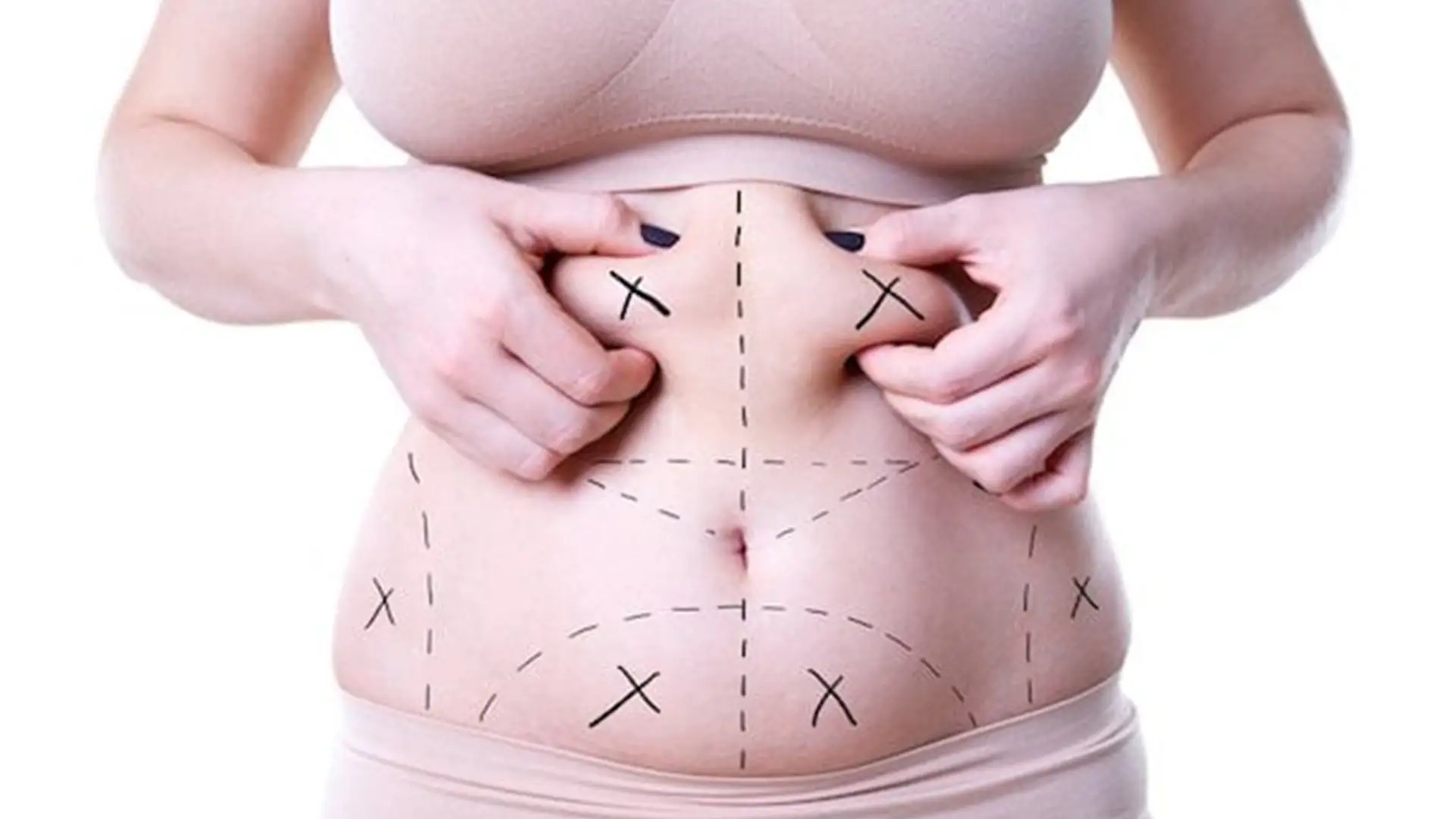 mega-liposucție-la-ce-să-te-aștepți-în-ziua-operației-de-liposucție-imic-înalt