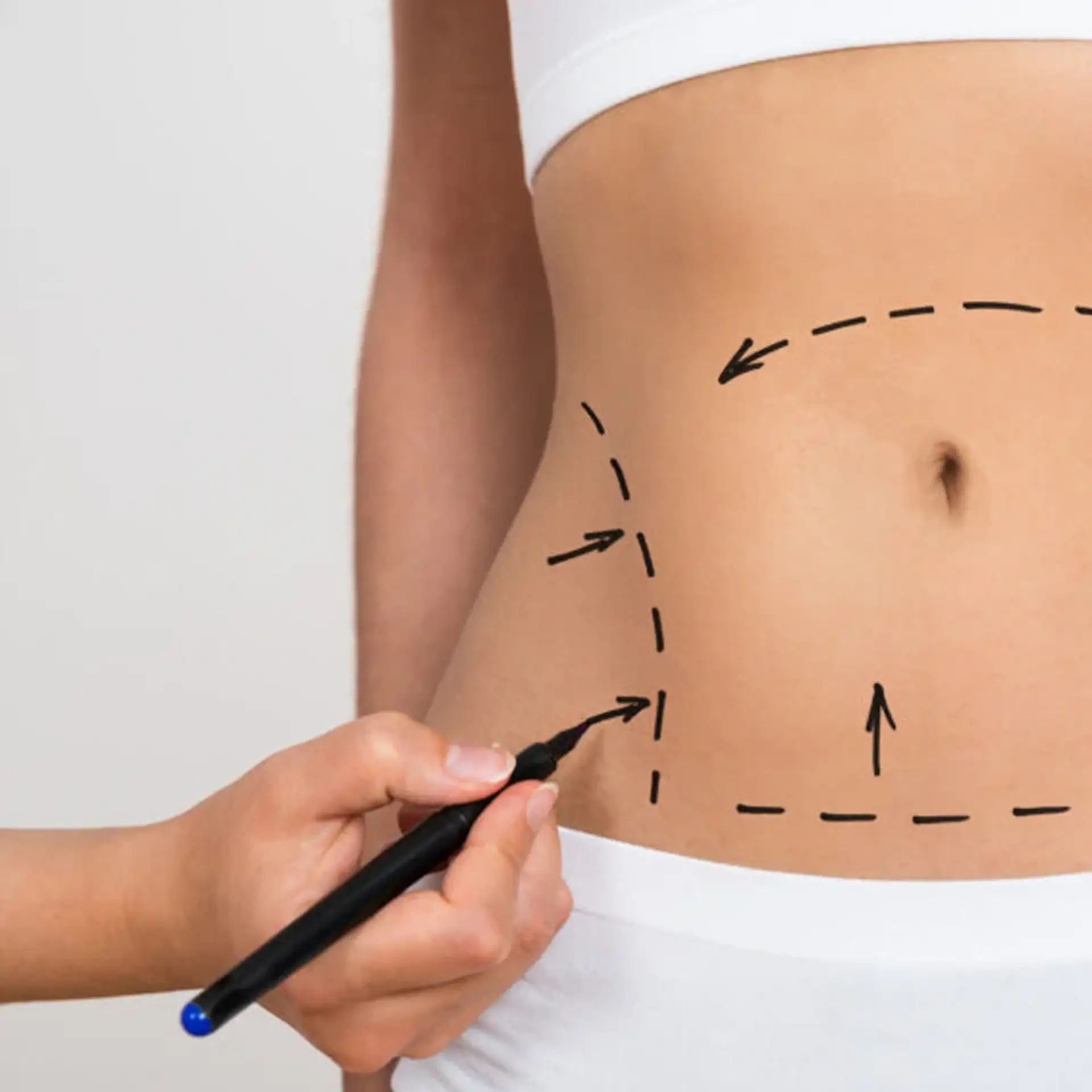 Quién-es-el-candidato-adecuado-para-cirugía-de-abdominoplastia