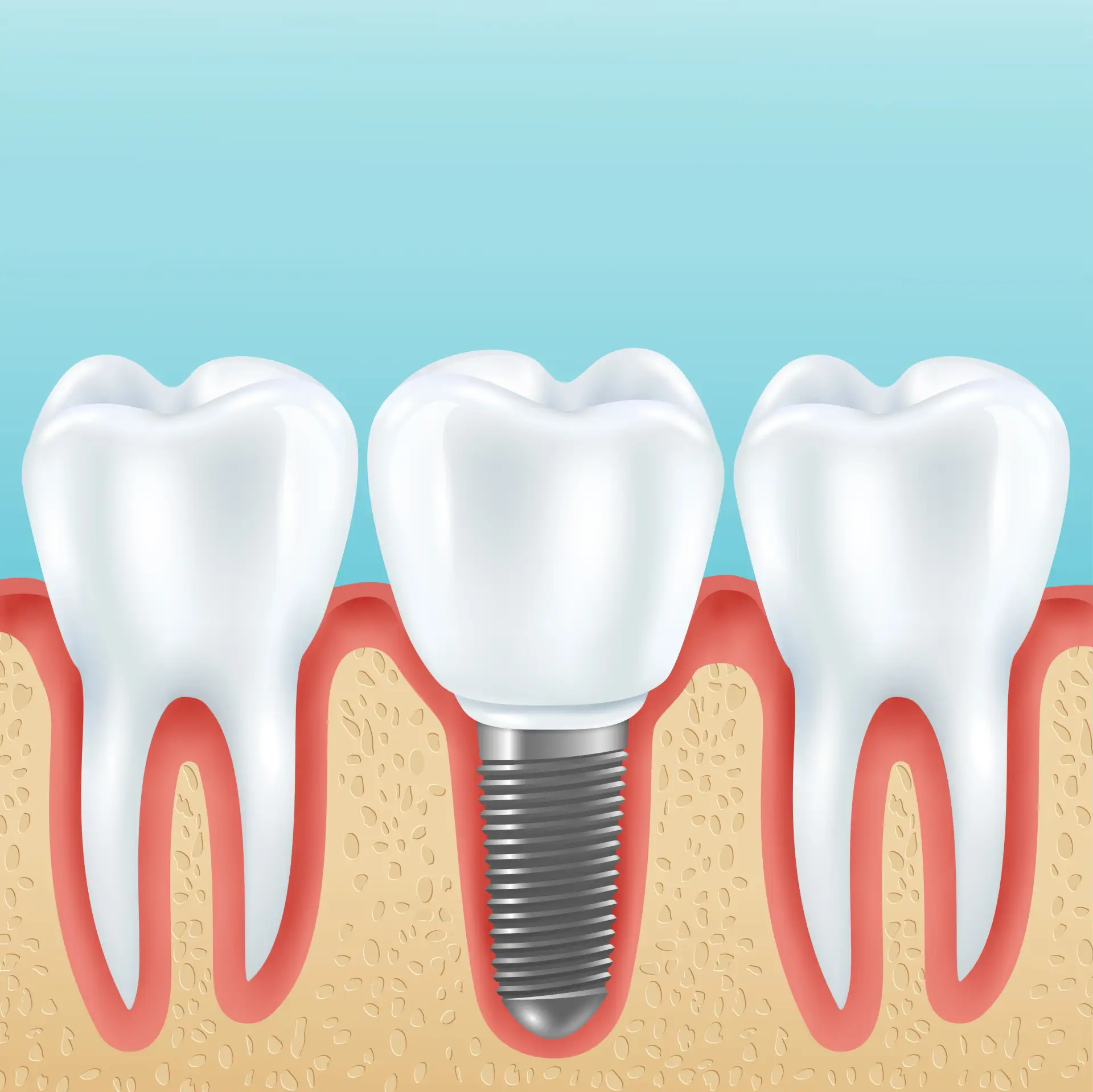 implantes-dentales