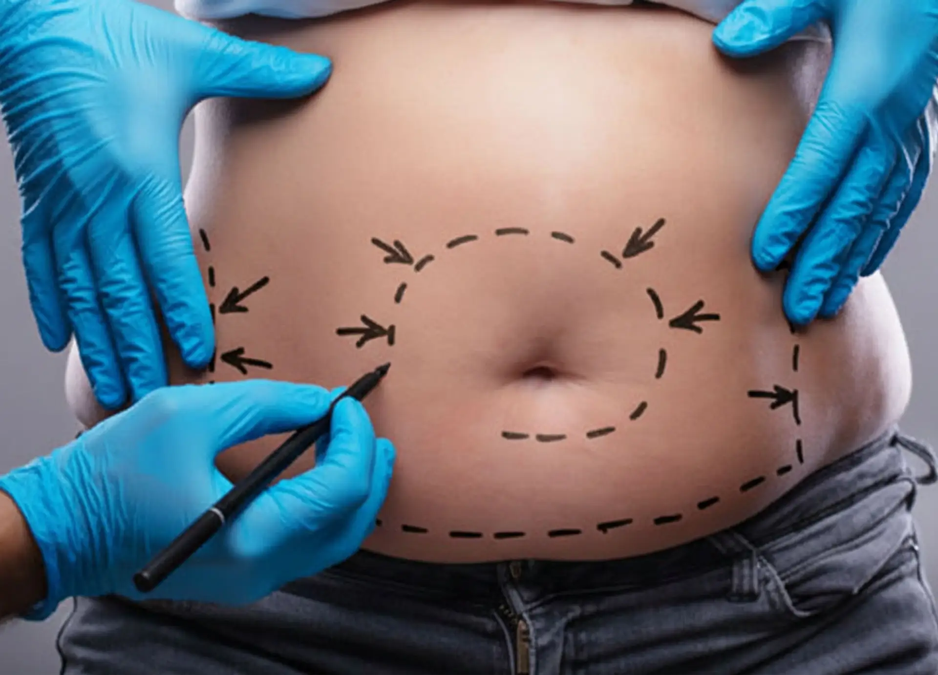 mega-liposucción-qué-esperar-el-día-de-la-cirugía-de-liposucción-de-alto-IMC