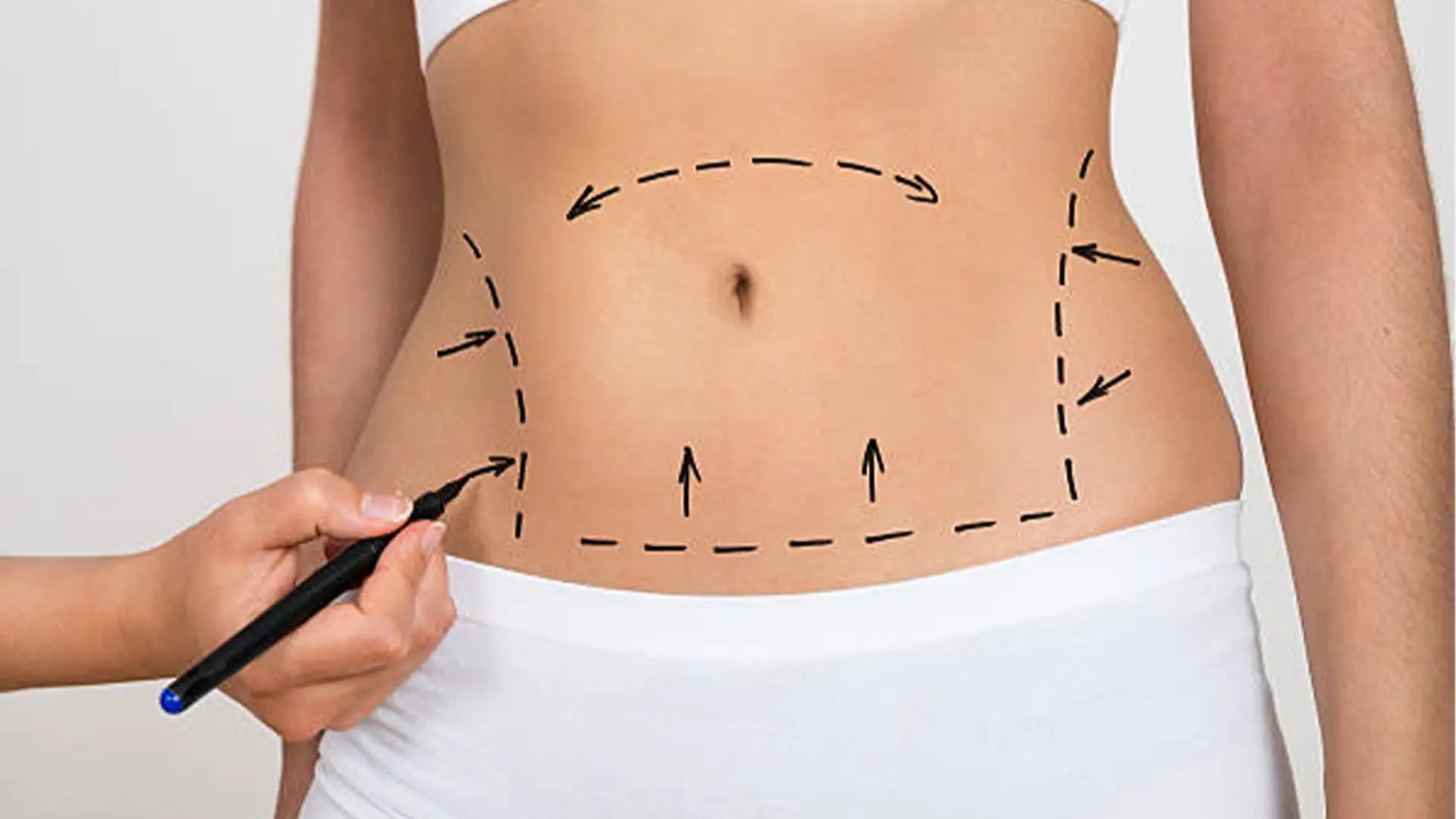 mega-liposucția-cum-se-începe-cu-liposucția-în-turcia