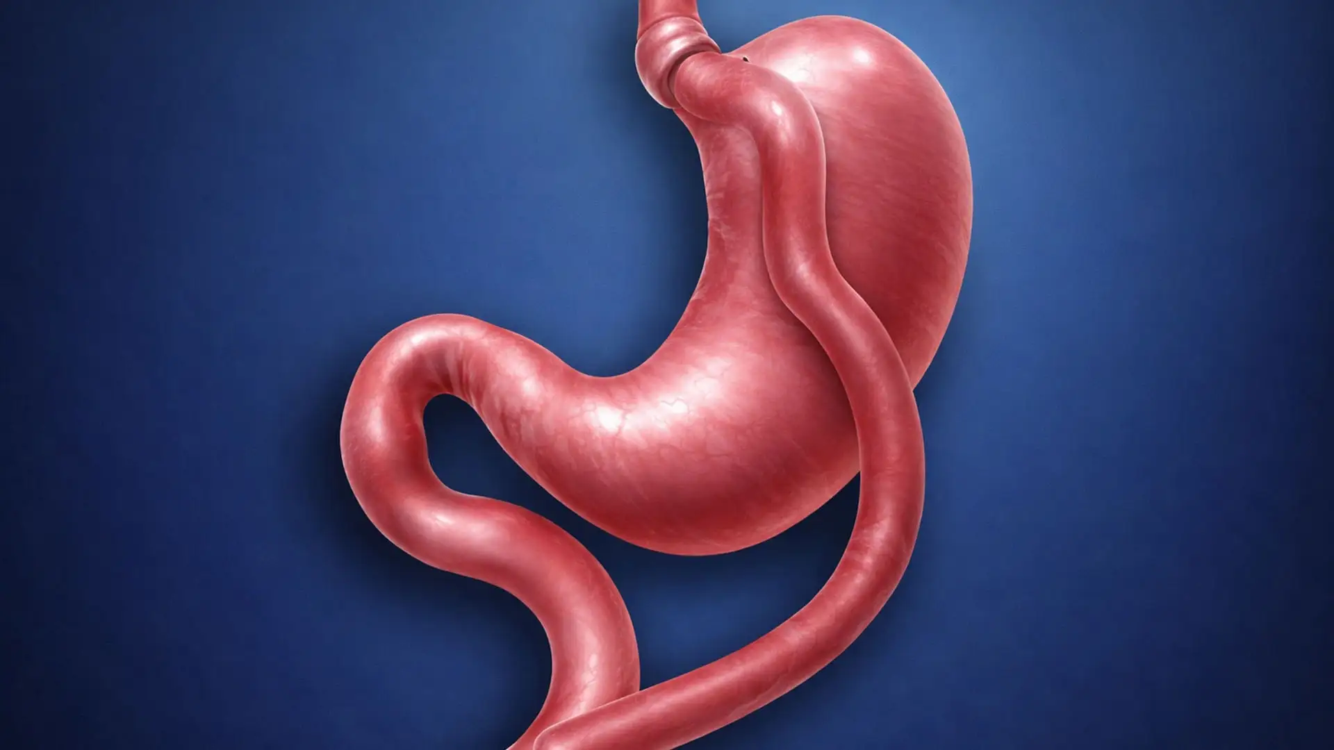 obesidade-desvantagens-da-cirurgia-de-bypass-gástrico