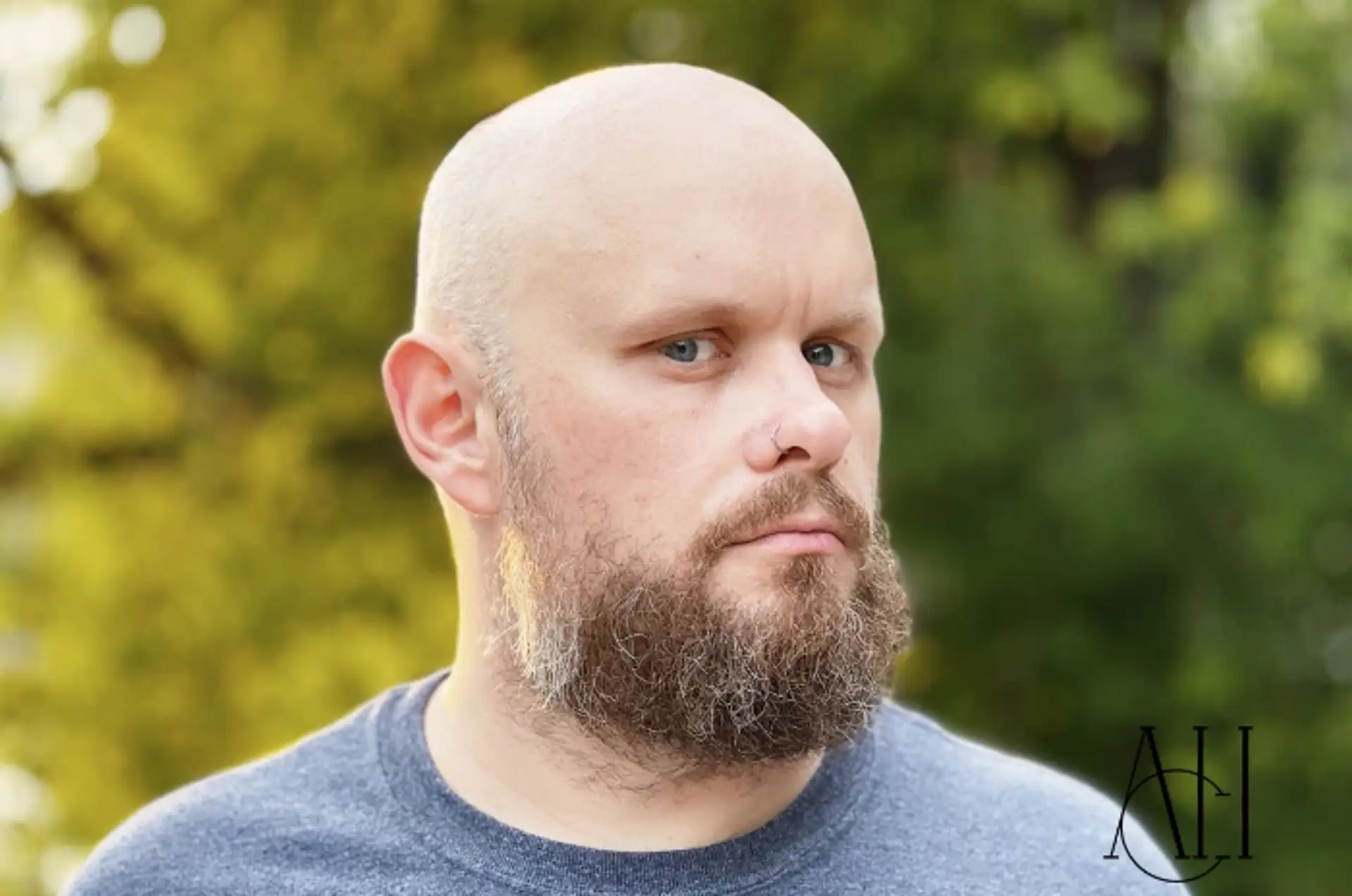 beard-transplant