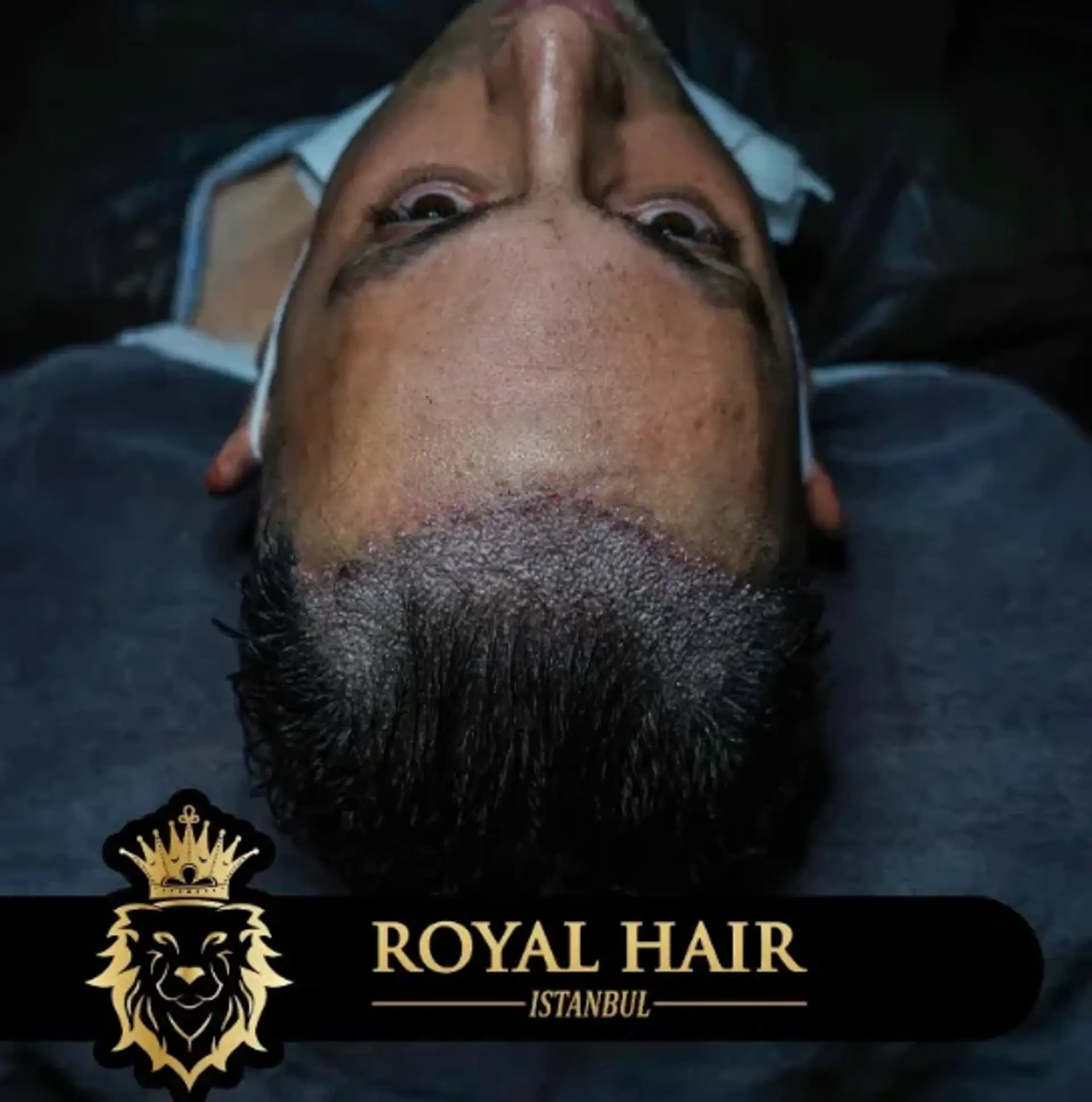 Understanding Hair Transplant Cost in Albania: Affordable Solutions for Hair Restoration