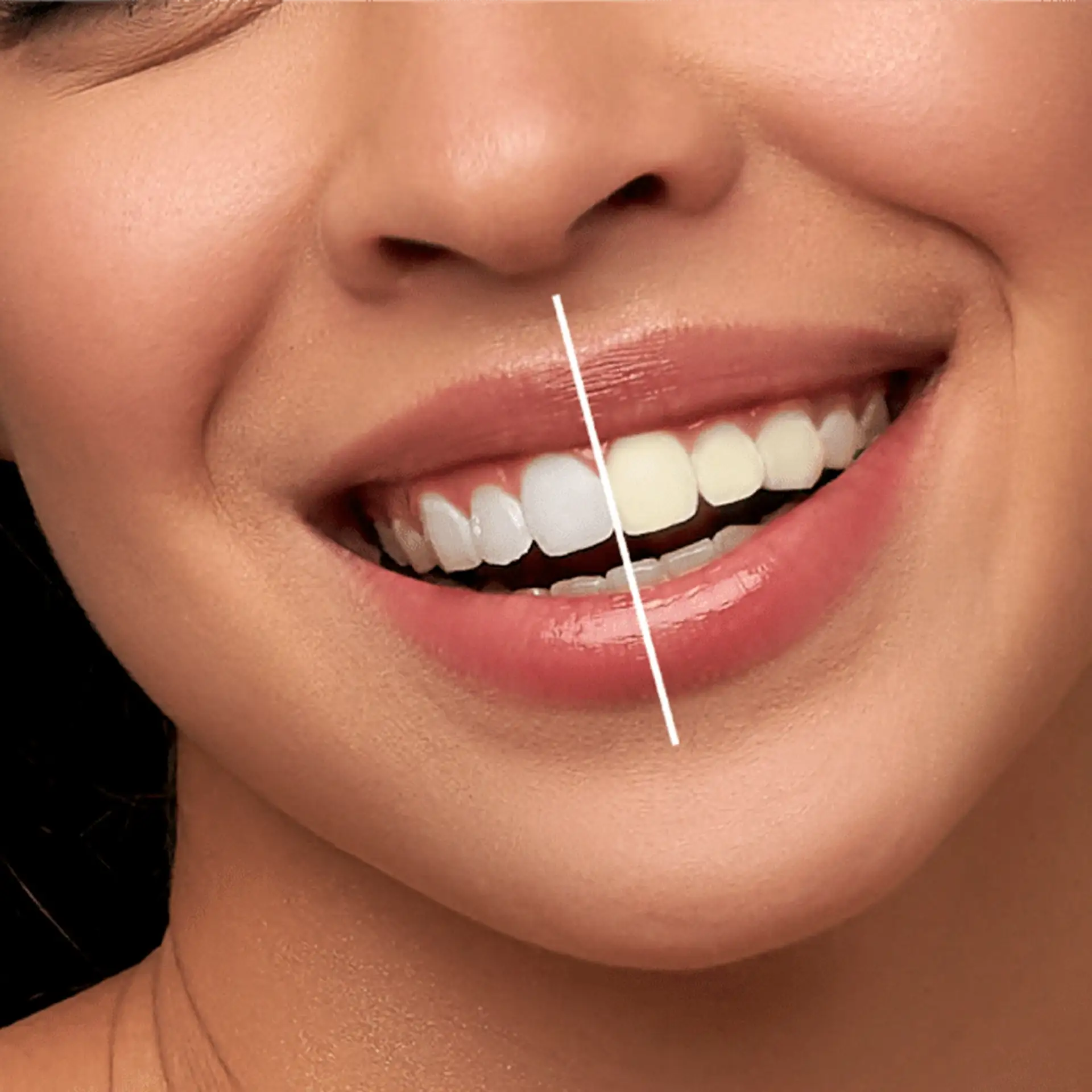 teeth-whitening