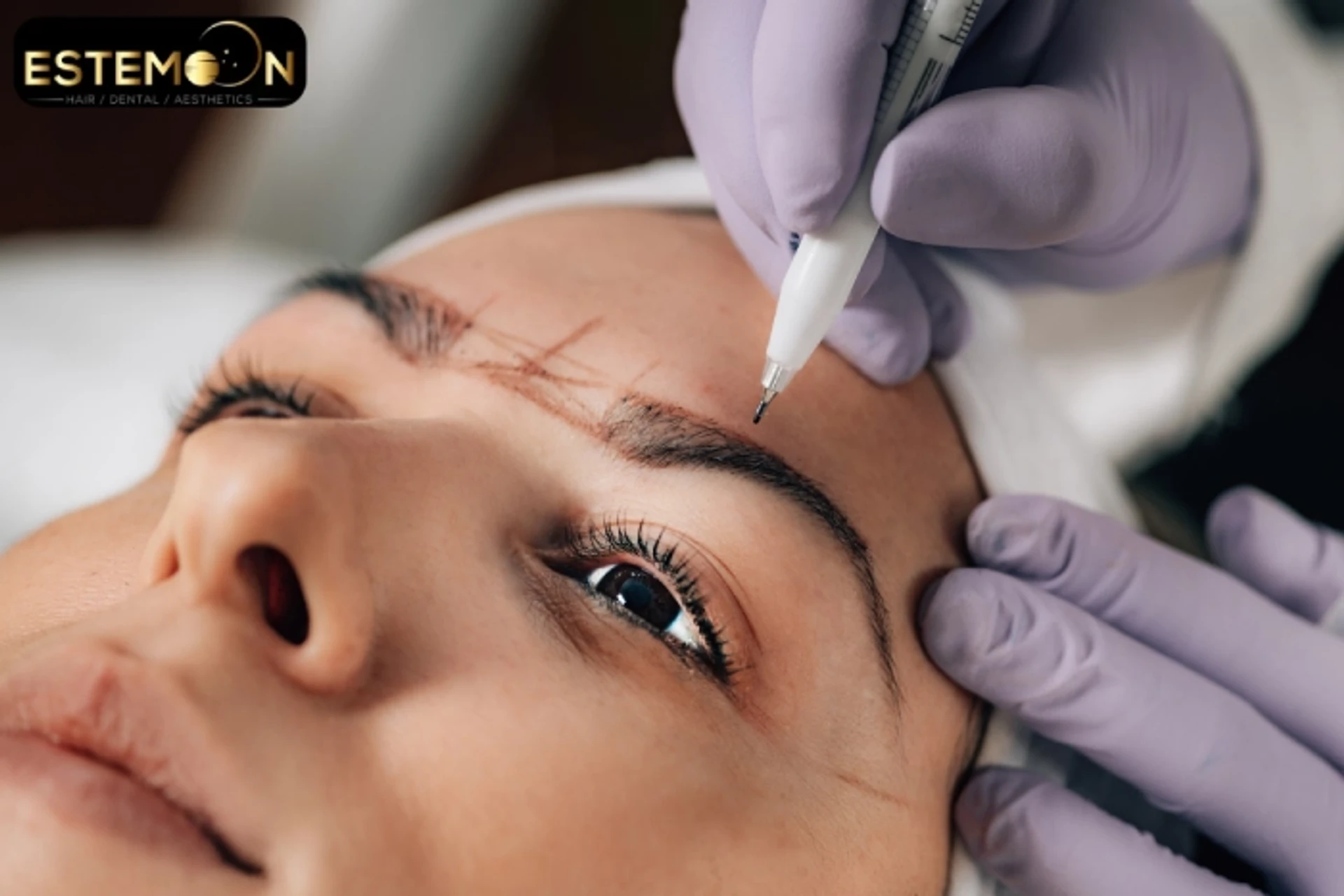Augenbrauen-Haartransplantation in der Türkei Estemoon Clinic