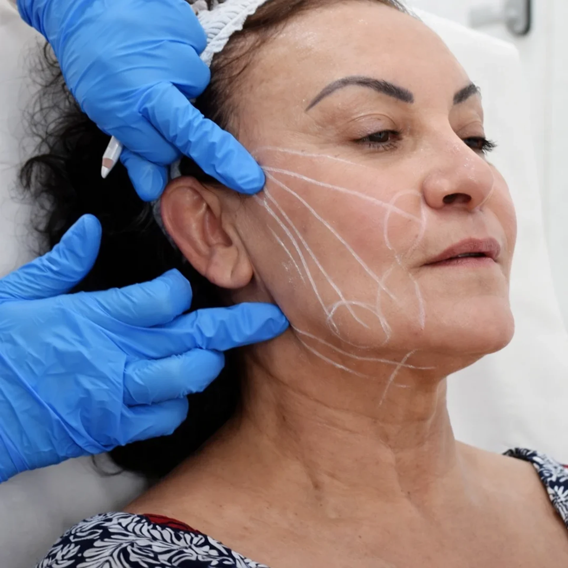 Was ist Facelift in der Türkei