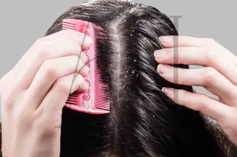 Dandruff vs. Dry Scalp