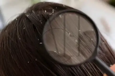 dandruff hair women