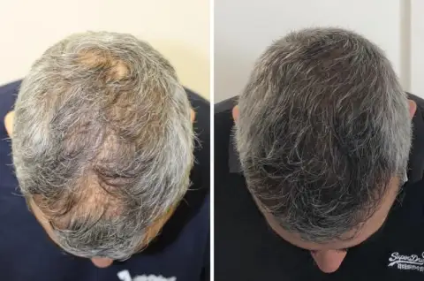 hair loss gene therapy