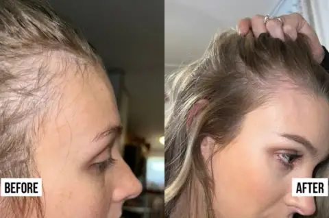 Postpartum hair regrowth