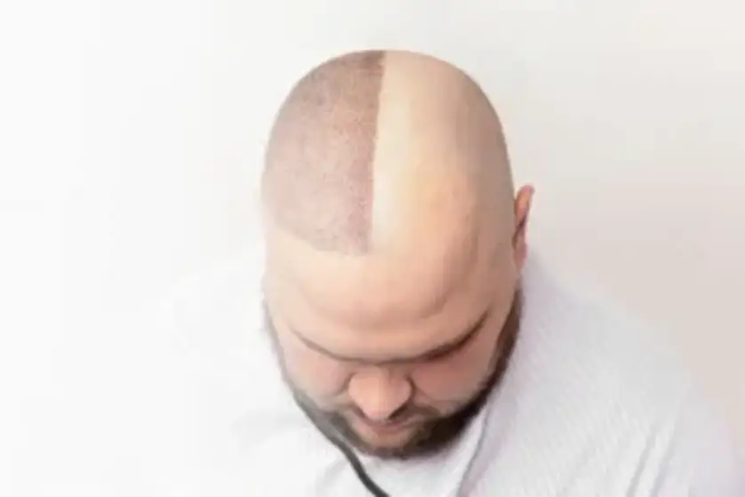 FUE hair transplant in Turkey — follicles harvested one by one