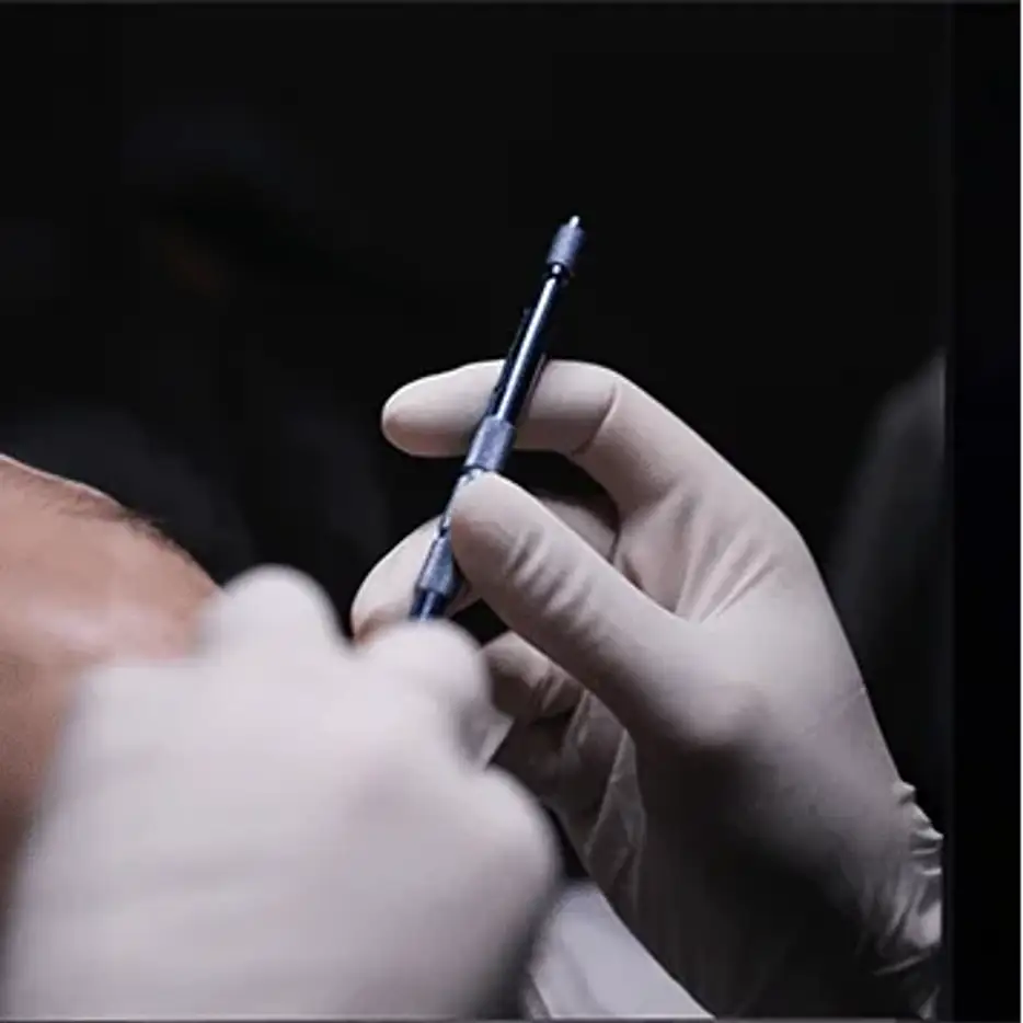 Close-up of a gloved hand holding a fine bladed instrument used to open recipient channels in the scalp.