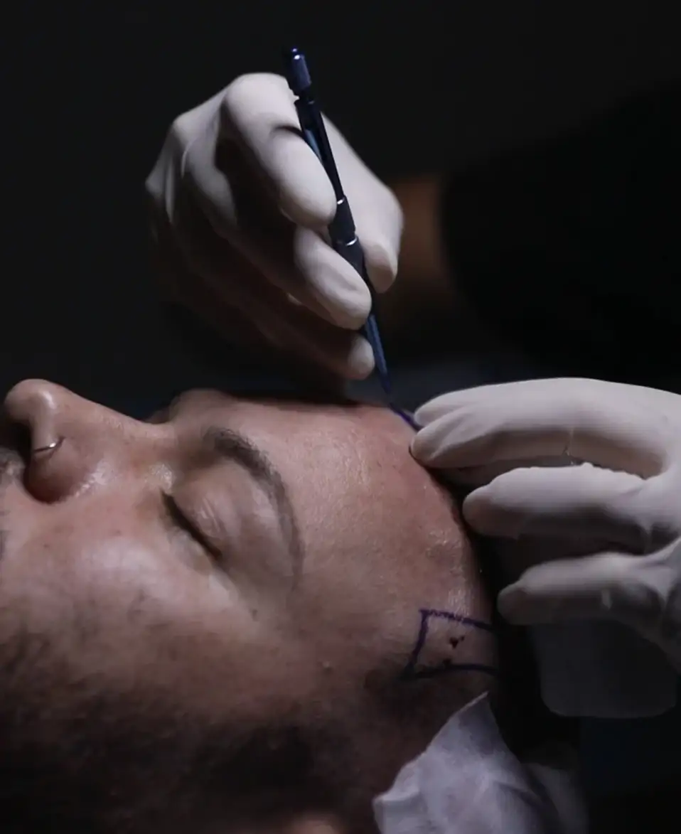 Gloved hands working over the forehead of an unidentified patient lying back, with a planned hairline drawn on the skin in marker.
